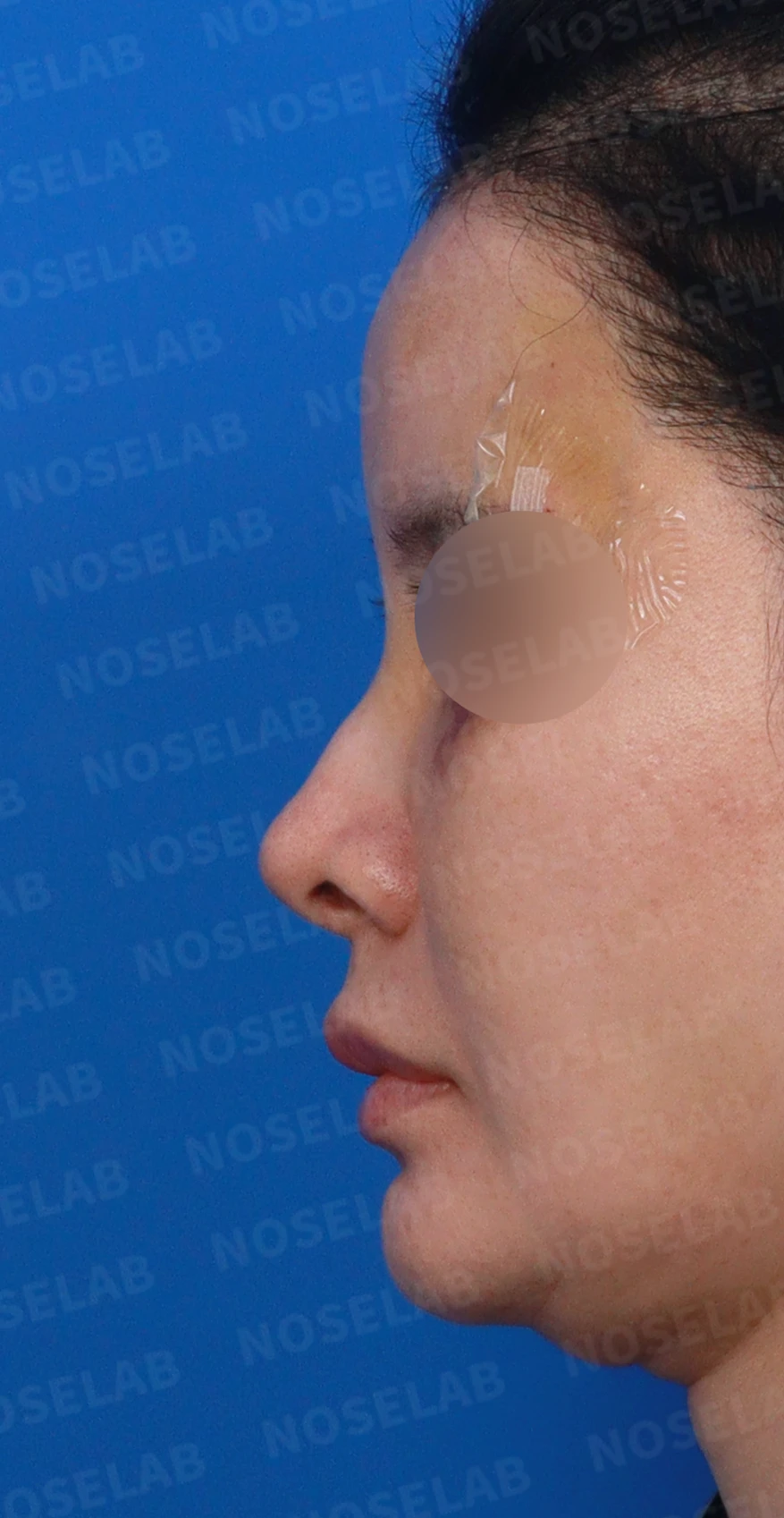 외상으로 코뼈가 부러지면 코가 어떻게 변형되고, 정복과 재건은 어떻게 하나 — 디자인 상담 정면, 좌측 측면, 비스듬한 측면 사진입니다.