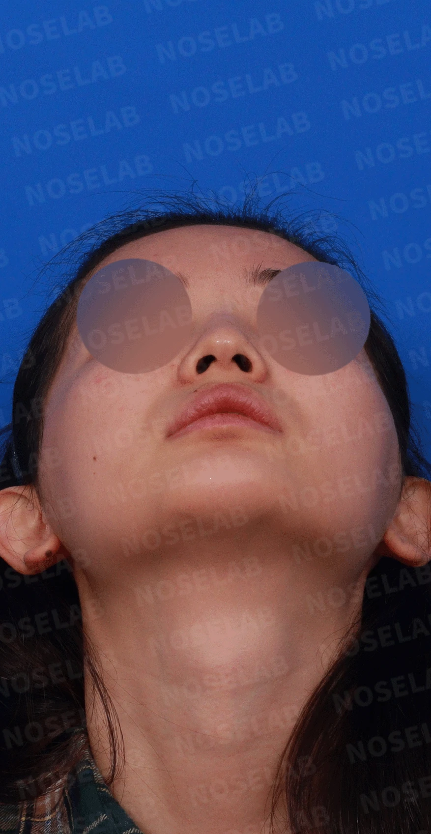 웃을 때만 화살코가 되는 이유와 코끝 연골 교정 방법 — 디자인 상담 우측 비스듬한 측면, 측면, 비공 사진입니다.