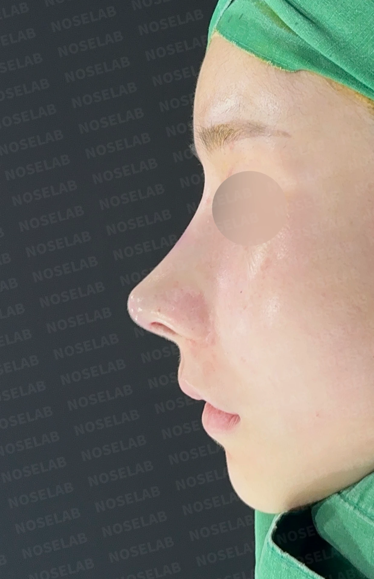 코성형 뒤 코끝이 들리고 비주가 짧아 보이는 이유, 비주 하강과 콧대 라인 교정 방법 — 수술 전 / 수술 직후 0일 직후 사진은 부기가 있는 상태로 최종 결과와 다를 수 있습니다.