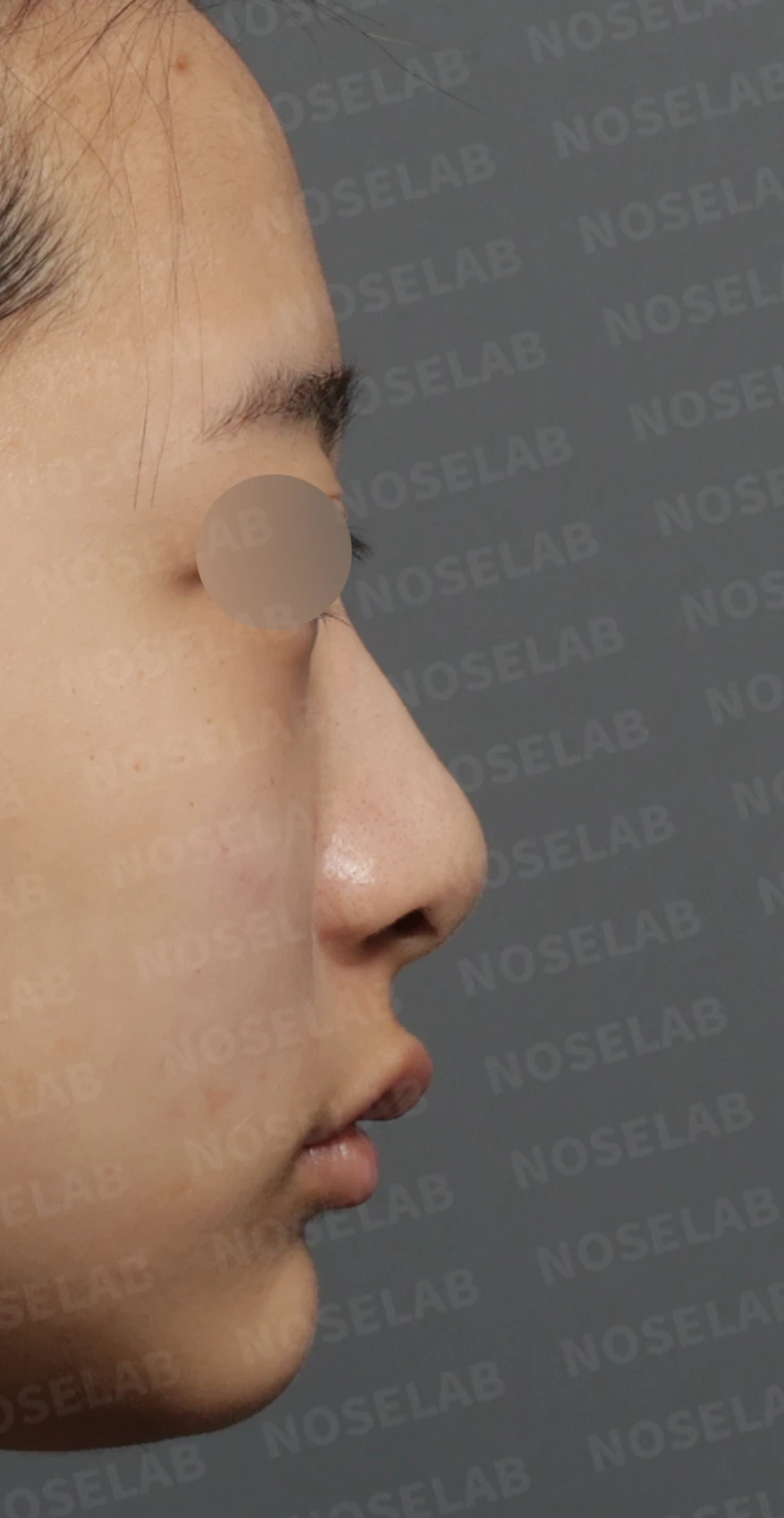 들린 코와 처진 비주, 비중격연장술로 자연스러운 직반라인 완성한 코성형 — 디자인 상담 우측 측면, 비스듬한 측면, 비공 사진입니다.