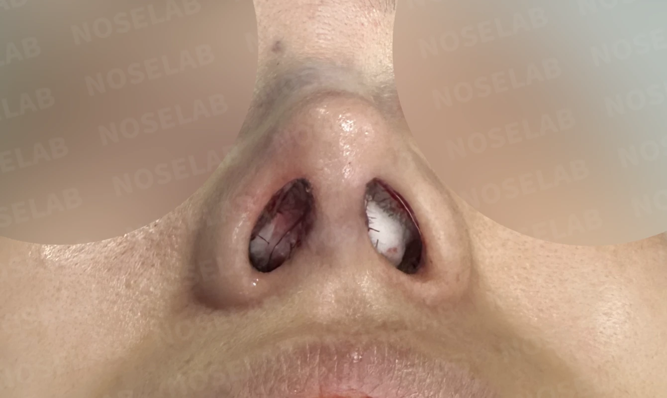 비공 비대칭과 휘어진 코, 자가늑연골 재건으로 교정한 코재수술 — 직후 비공 사진