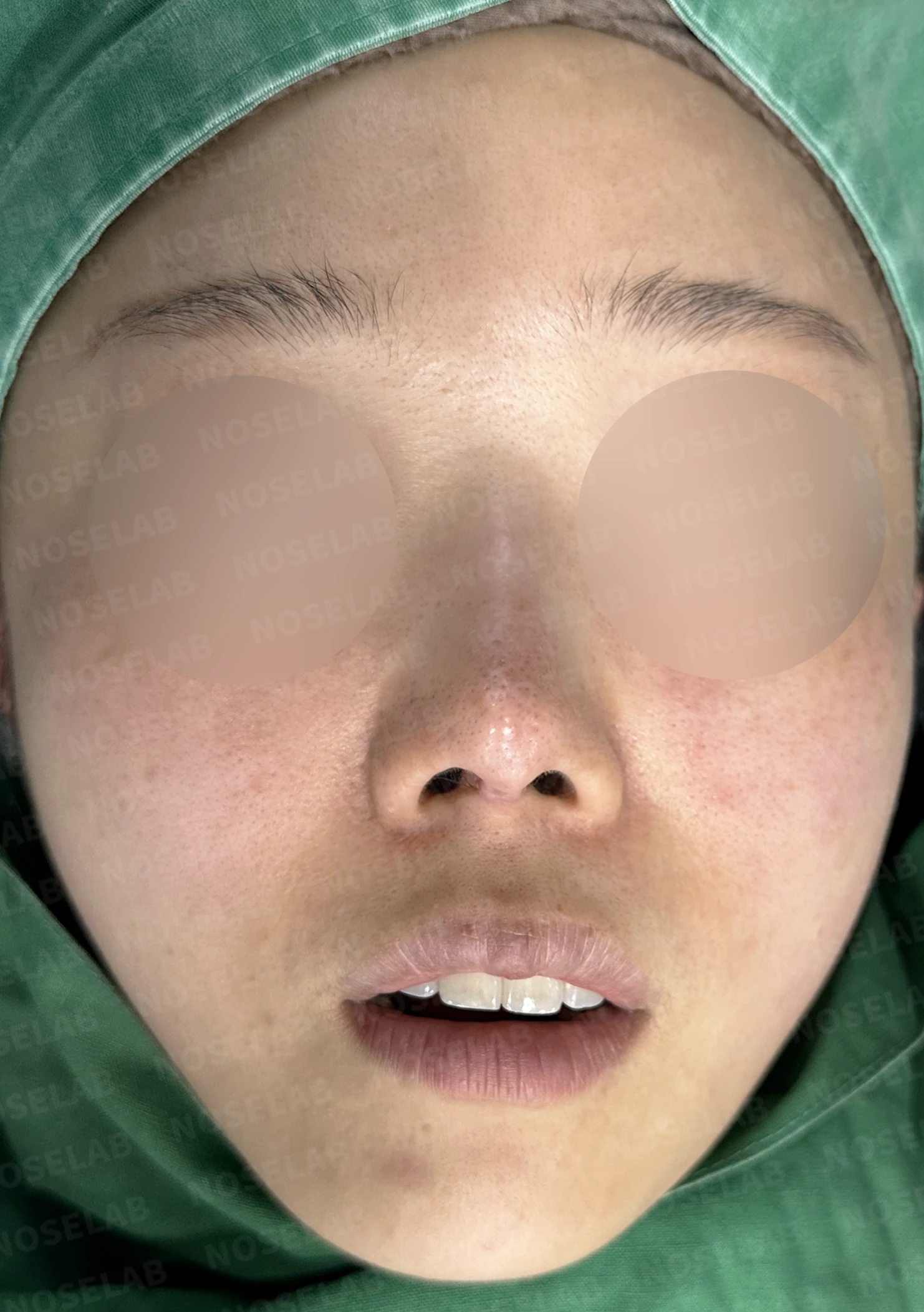 코끝 피부가 얇아져 연골이 비치는 이유, 피부 보강은 어떻게 하나 — 수술 전 / 수술 직후 0일 직후 사진은 부기가 있는 상태로 최종 결과와 다를 수 있습니다.