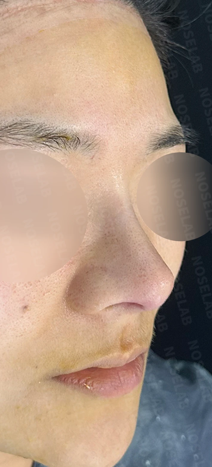 복코 수술은 어떻게 하나요? — 수술 직후 0일 사진들 90도 측면, 45도 측면, 정면 직후 사진은 부기가 있는 상태로 최종 결과와 다를 수 있습니다.
