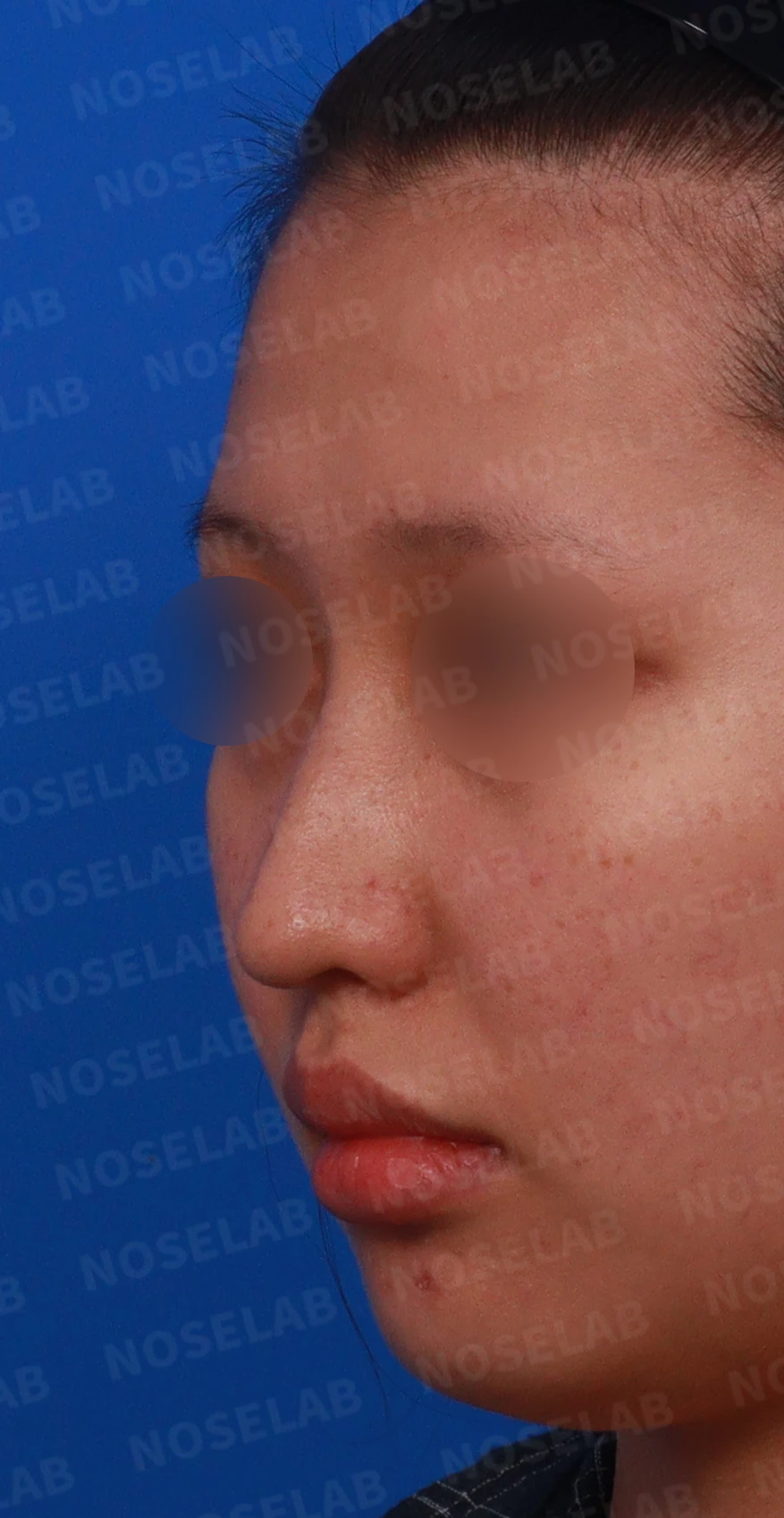 매부리코와 처진 코끝이 함께 있을 때, 콧대와 코끝의 균형 잡는 법 — 디자인 상담 정면 , 좌측 비스듬한 측면 , 측면 사진입니다.