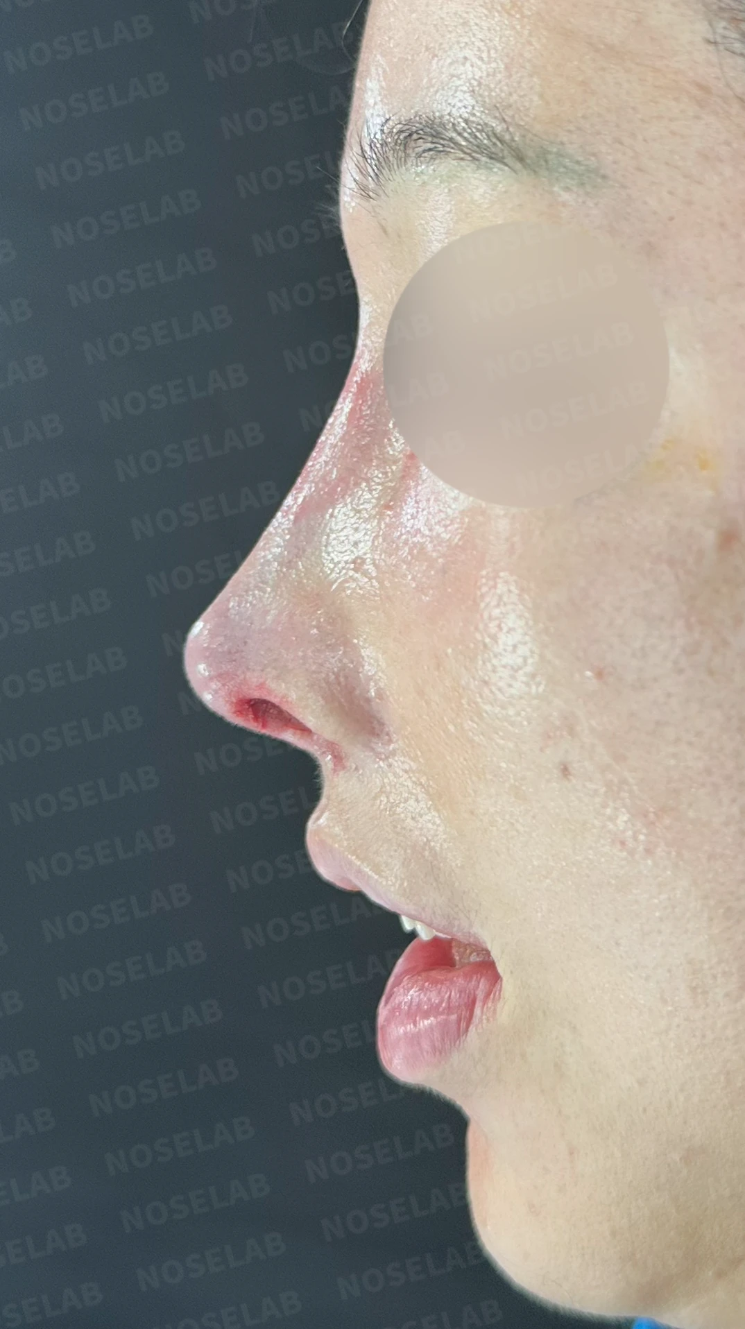 다수 재수술 후 인공진피 흡수와 비중격 손상 재건 사례 — 직후 정면 , 측면 , 비스듬한 측면 사진