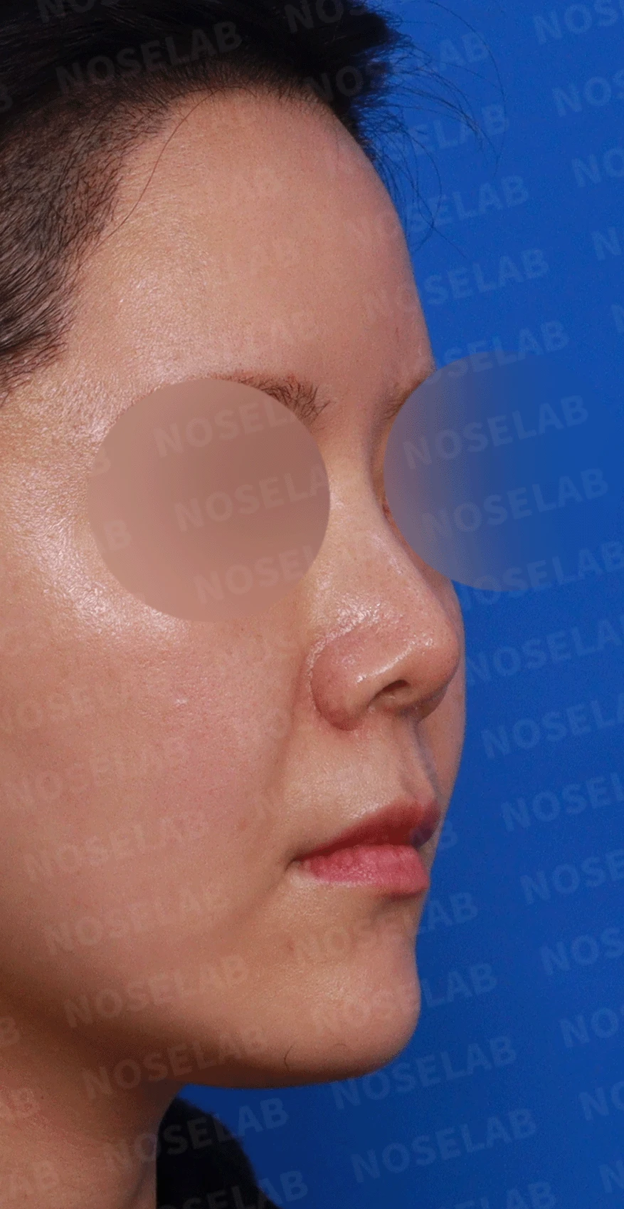 늑연골 석회화를 미리 확인해야 하는 이유와 휜코·짧은코 교정 방법 — 디자인 상담 우측 측면 , 비스듬한 측면 , 비공 사진