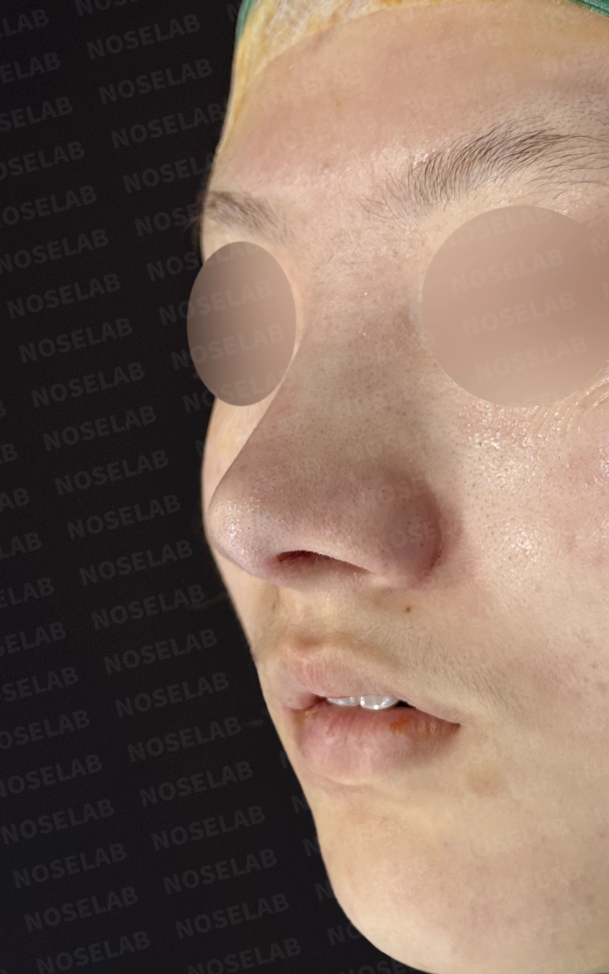 뭉툭한 코끝과 퍼진 코, 자가늑연골 비중격 연장술로 자연스럽게 교정 — 전(좌) 직후(후)