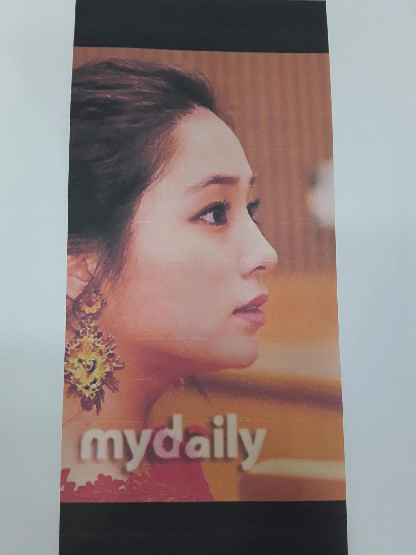 비중격 연골이 약해진 코, 보형물 없이 재건하는 방법 — 본문 사진 8