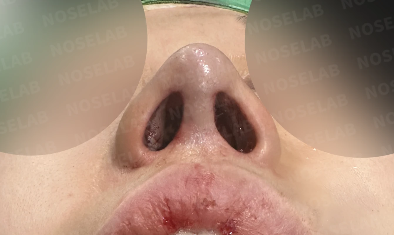 콧구멍 좌우가 심하게 달라 보이는 이유, 연골 재건과 피부이식 교정은 어떻게 하나 — 수술 전 / 수술 직후 0일 직후 사진은 부기가 있는 상태로 최종 결과와 다를 수 있습니다.