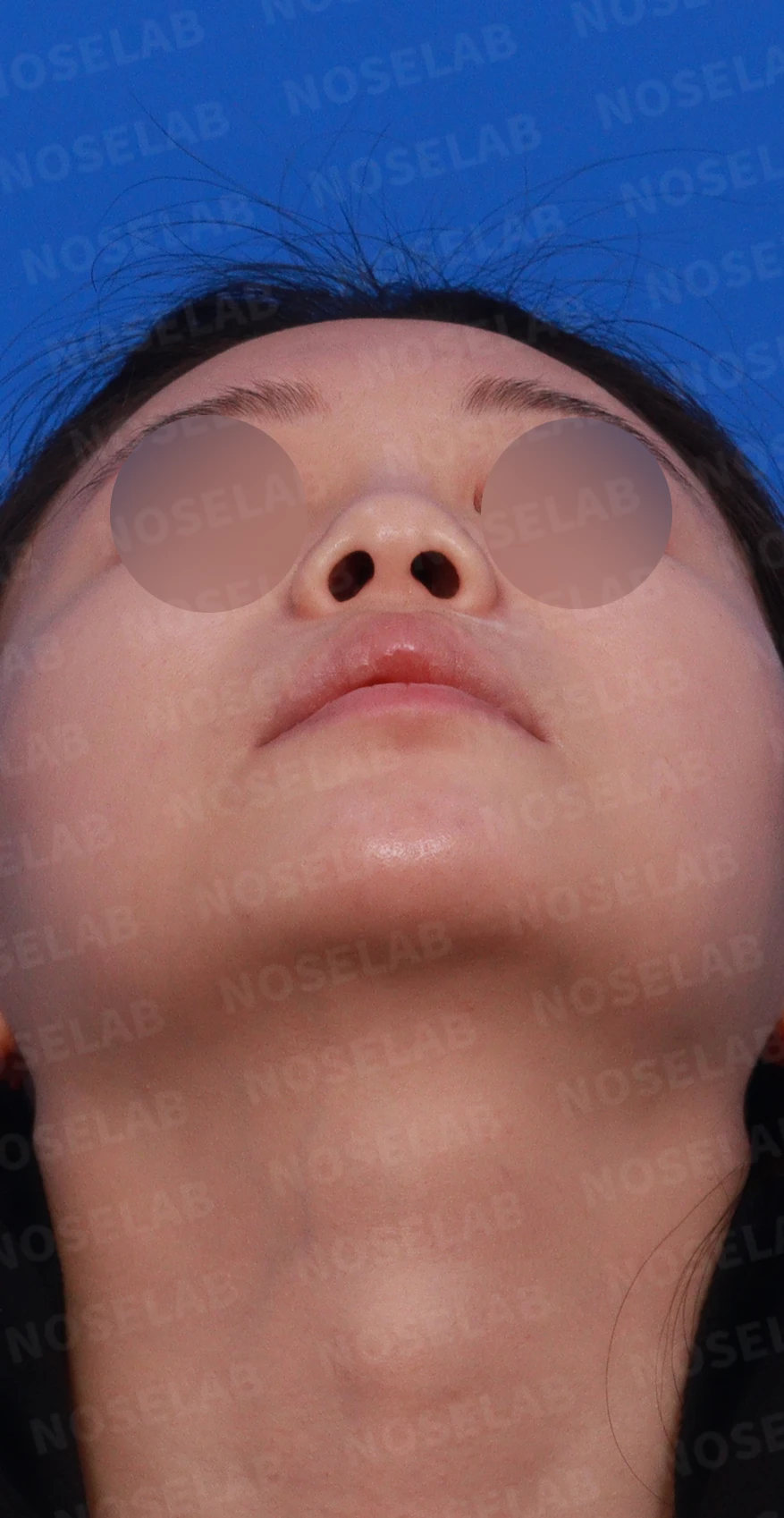 필러와 실이 남아 있는 코, 제거 후 늑연골 재건은 어디까지 가능한가 — 디자인 상담, 우측 비스듬한 측면, 측면, 비공 사진