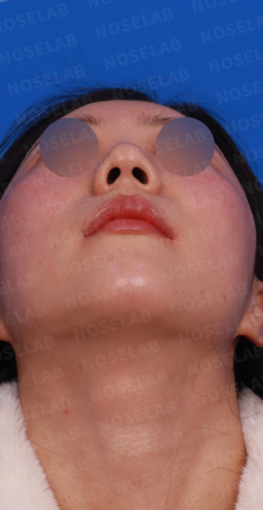 코뼈 비대칭과 처진 코끝에 만성 비염이 겹칠 때 보는 것 — 디자인 상담 정면, 우측 측면, 비스듬한 측면 사진