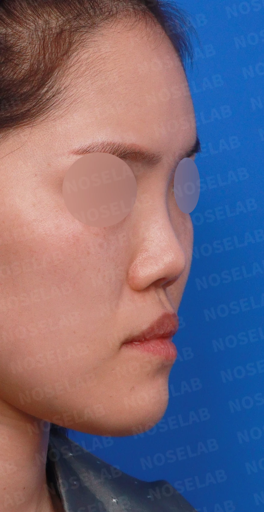 짧고 들린 코와 휜 코가 함께 생기는 이유, 비중격 연장 교정은 어떻게 하나 — 디자인 상담 우측 측면, 비스듬한 측면, 비공 사진입니다.