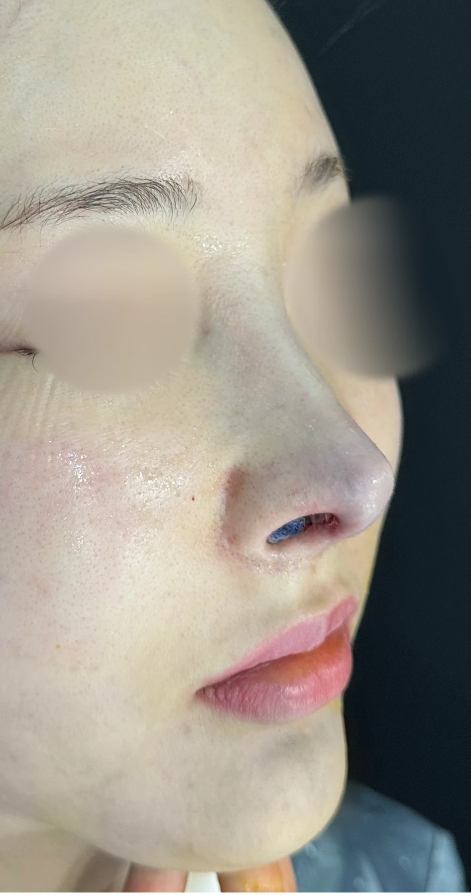 수술 후 14일 조기 교정에서 확인할 점 — 수술 직후 0일 사진 90도, 45도, 정면 직후 사진은 부기가 있는 상태로 최종 결과와 다를 수 있습니다.