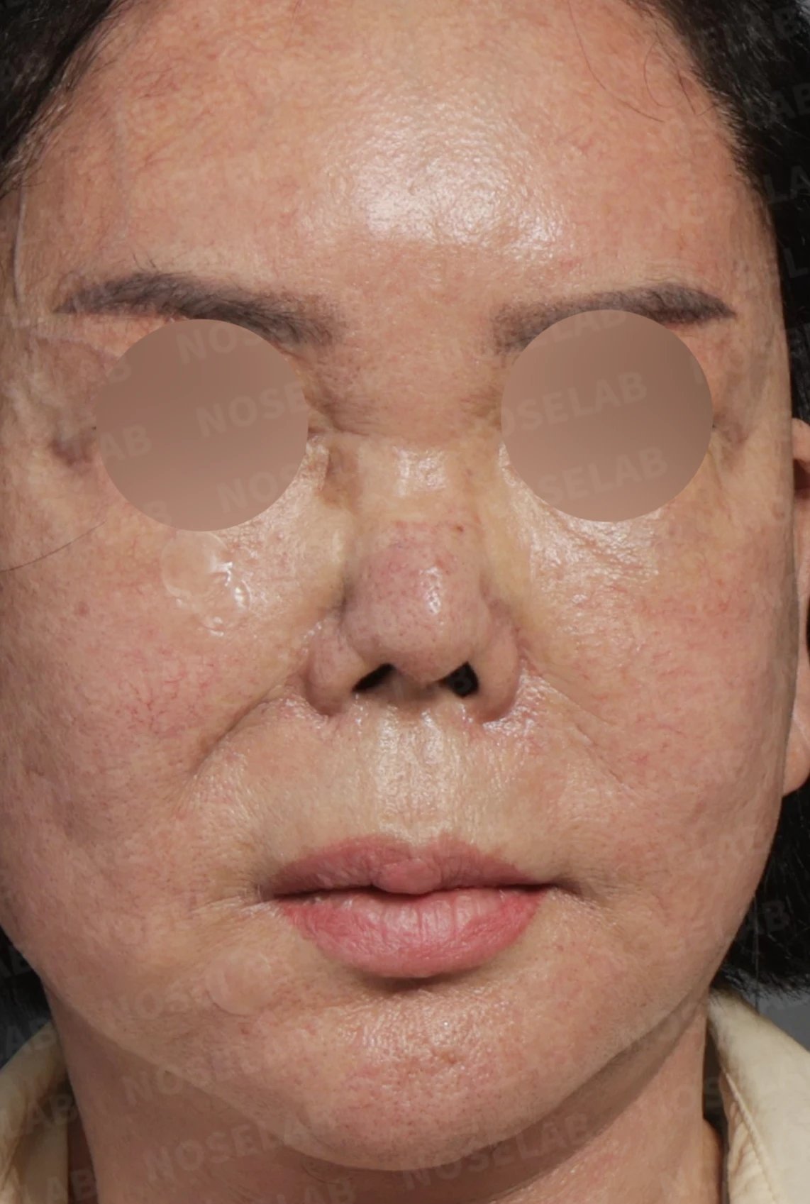 보형물 염증으로 손상된 코, 휴식기 후 기증늑연골로 안전하게 재건한 코재수술 — 디자인 상담 정면, 좌측 측면, 비스듬한 측면 사진입니다.
