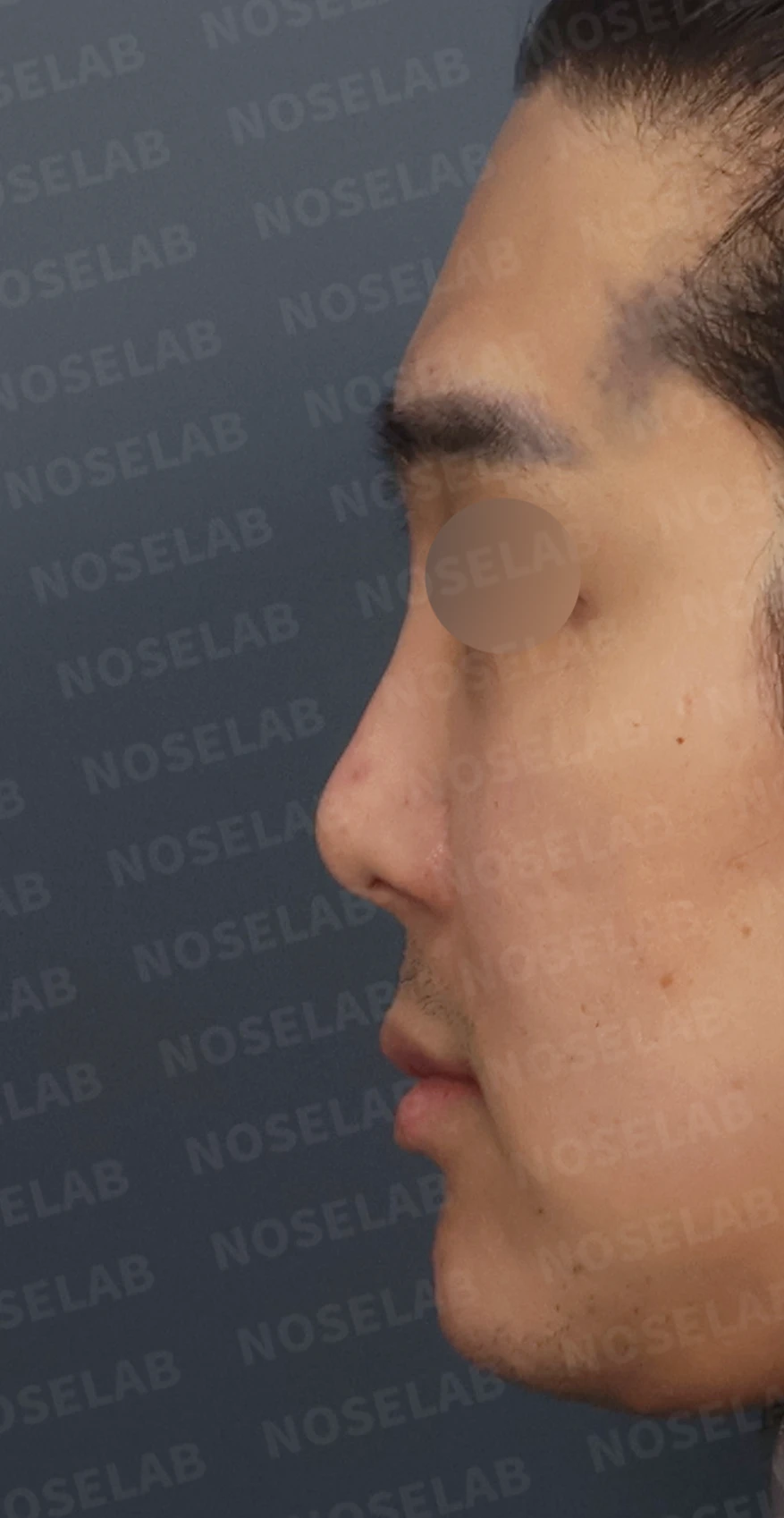 휜코 교정과 비공 비대칭, 자가늑연골로 바로잡은 코재수술 — 디자인 상담 정면, 좌측 측면, 비스듬한 측면 사진입니다.