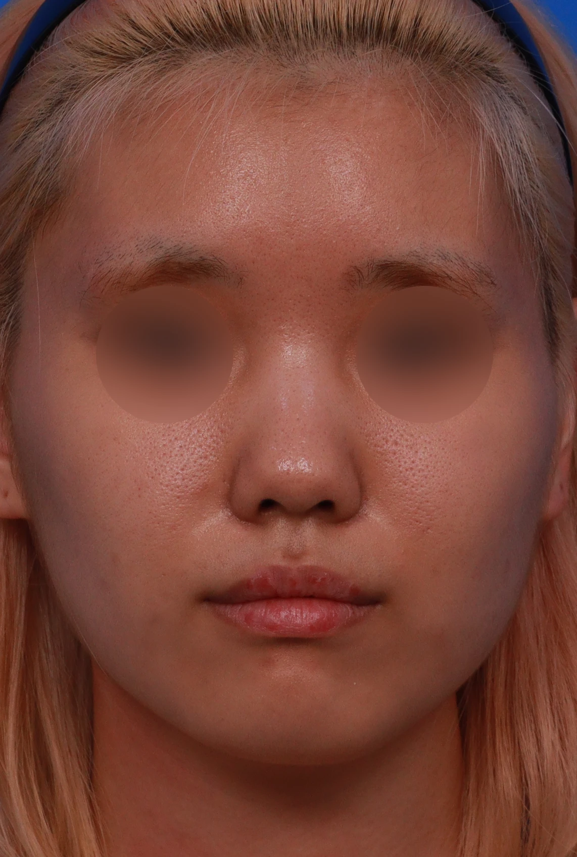 작고 뭉툭한 코는 어디까지 높일 수 있나 — 피부의 한계와 재건 방법 — 디자인 상담 정면 , 좌측 비스듬한 측면 , 측면 사진입니다.