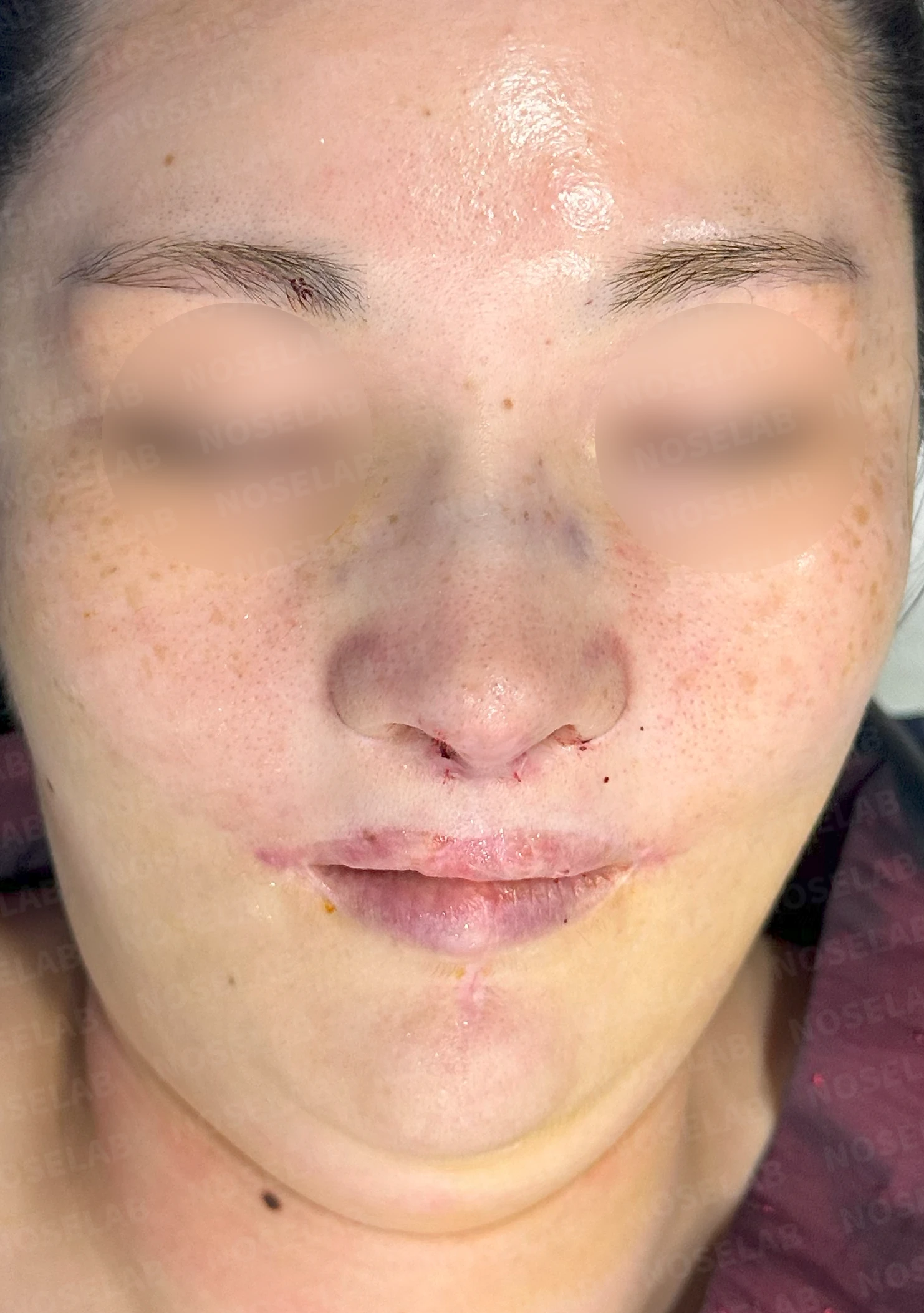 구순구개열에서 코 비대칭이 남는 이유와 늑연골·귀연골 재건 방법 — 수술 전 / 수술 직후 0일 직후 사진은 부기가 있는 상태로 최종 결과와 다를 수 있습니다.