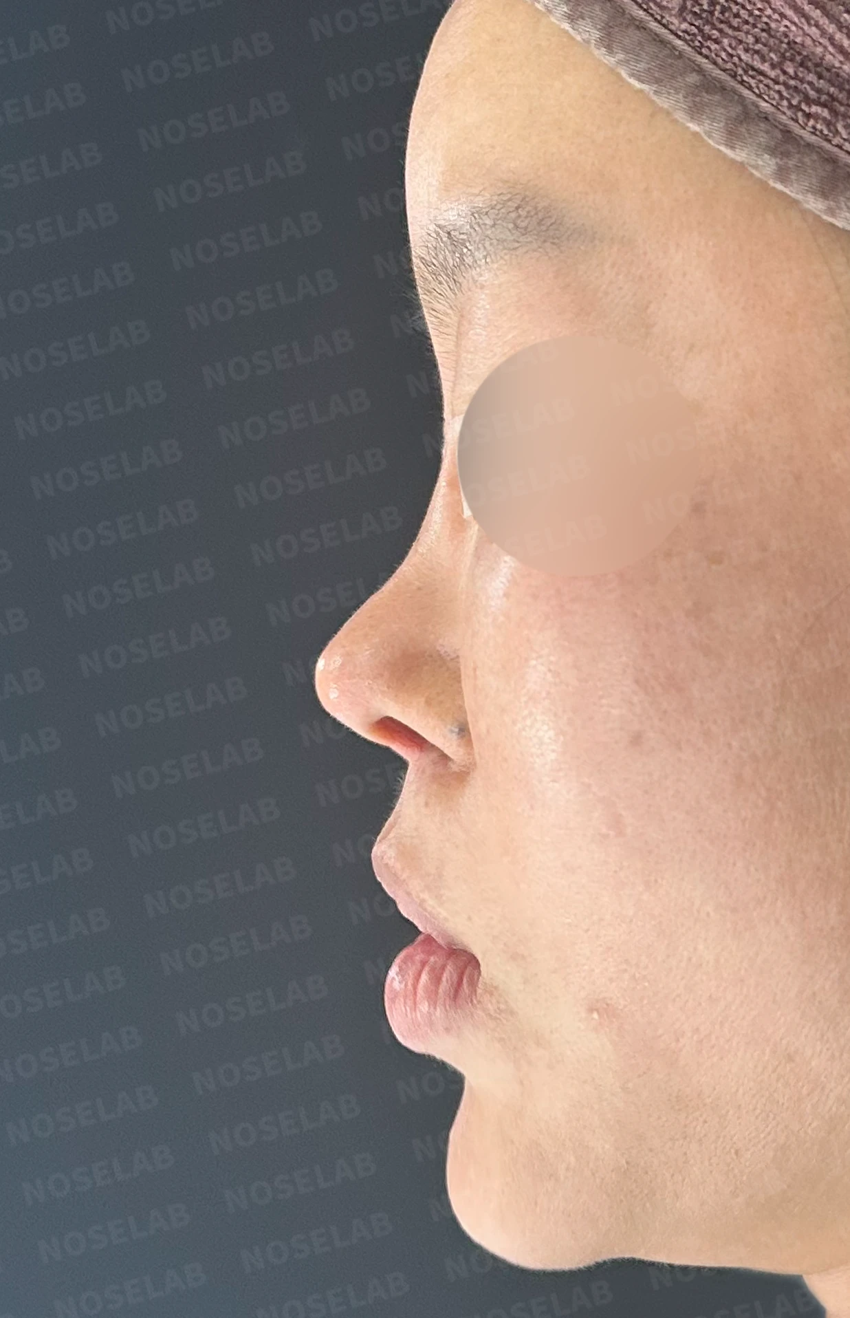 이식한 진피가 흡수되어 콧대가 퍼지고 코가 들려 보이는 이유와 교정 방법 — 수술 전 / 수술 직후 0일 직후 사진은 부기가 있는 상태로 최종 결과와 다를 수 있습니다.