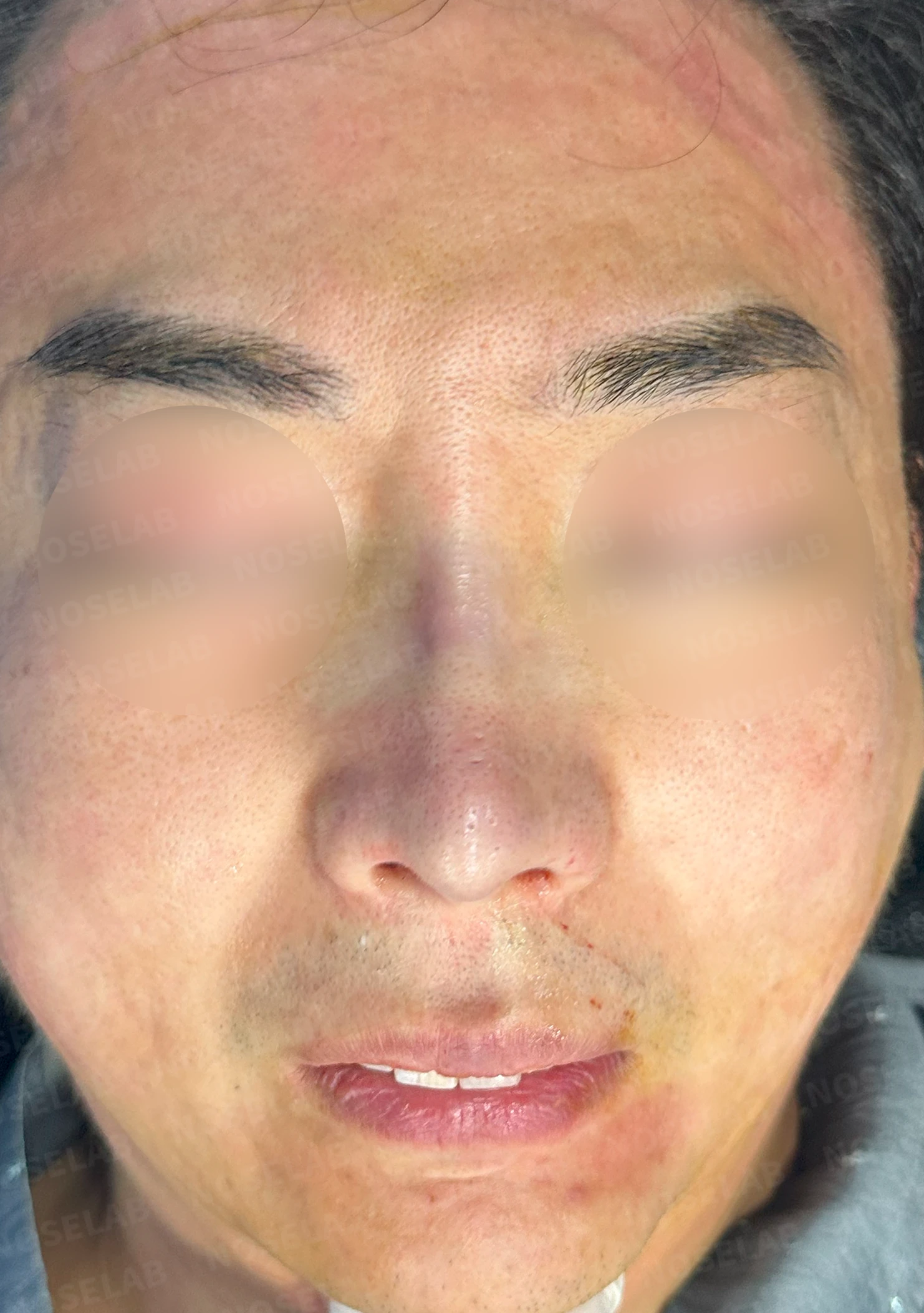 매부리코 수술 후 비대칭의 재수술 방법 — 수술 전 / 수술 직후 0일 직후 사진은 부기가 있는 상태로 최종 결과와 다를 수 있습니다.