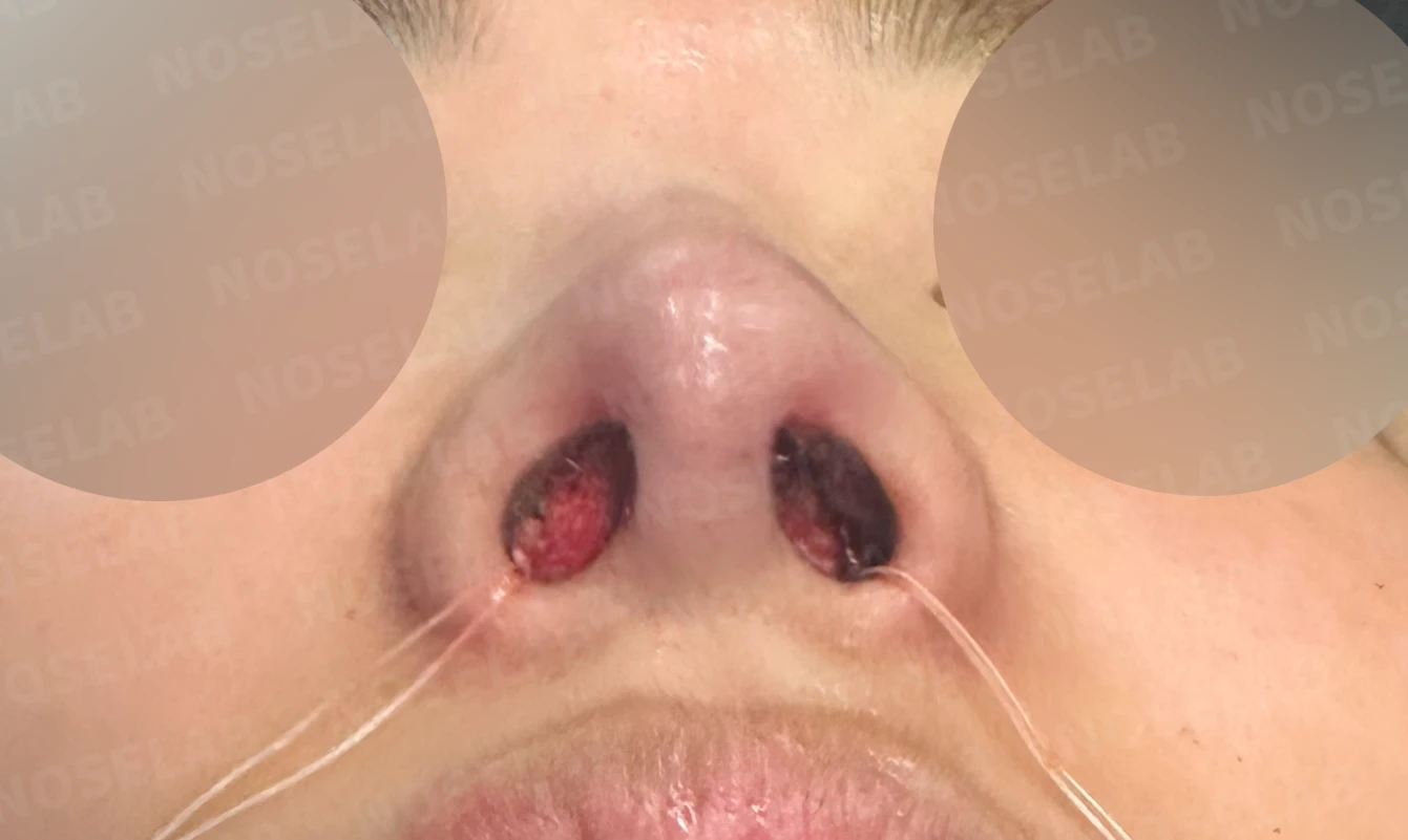 비염 수술을 받았는데도 코막힘이 돌아오는 이유, 구조 교정은 어떻게 하나 — 수술 직후 0일 비공 사진입니다. 직후 사진은 부기가 있는 상태로 최종 결과와 다를 수 있습니다.