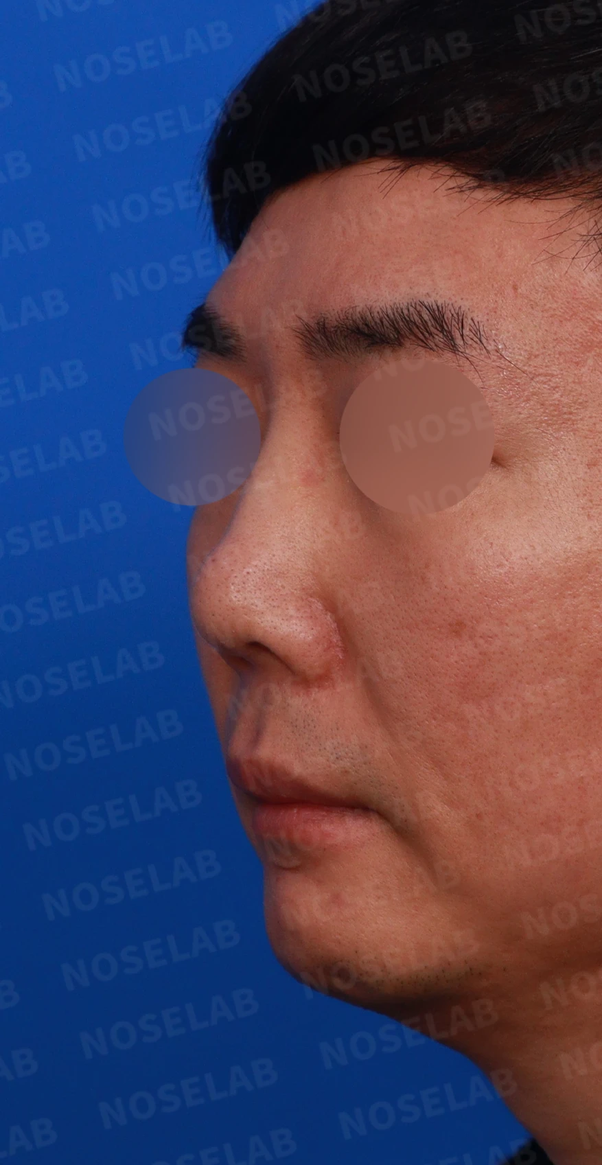 매부리코 수술 후 비대칭의 재수술 방법 — 디자인 상담 정면, 좌측 측면, 비스듬한 측면 사진