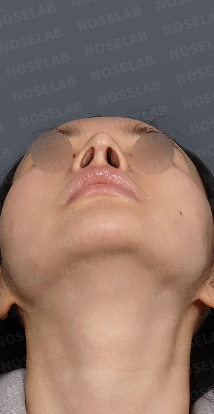 여러 차례 수술 뒤 코막힘이 남는 이유, 비중격과 비밸브 재건은 어떻게 하나 — 디자인 상담 정면, 좌측 측면, 비스듬한 측면 사진입니다.