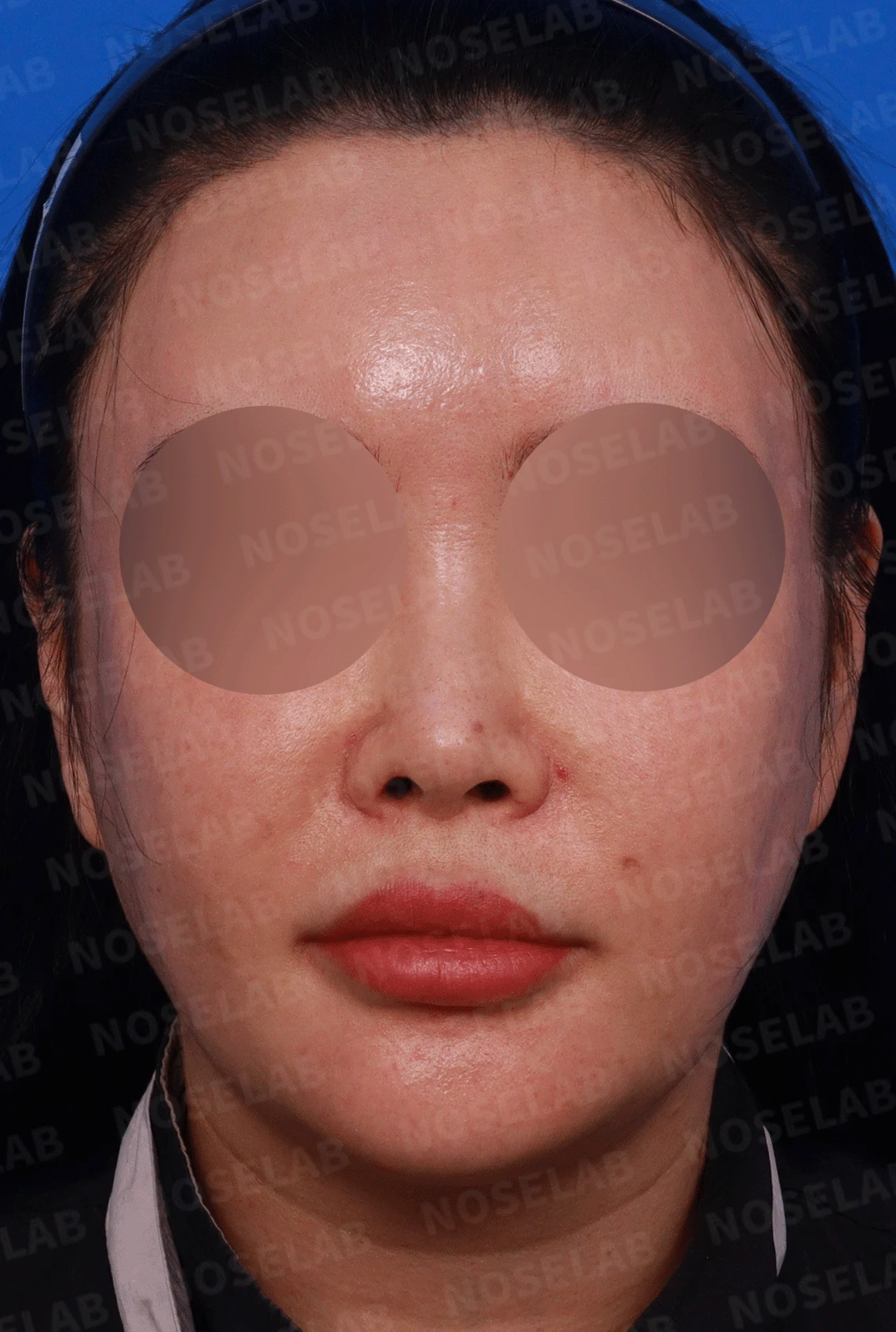 제거했다던 주사 이물질이 남는 이유와 들린 코끝 교정 방법 — 디자인 상담 정면, 좌측 , 비스듬한 측면 , 측면 사진입니다.