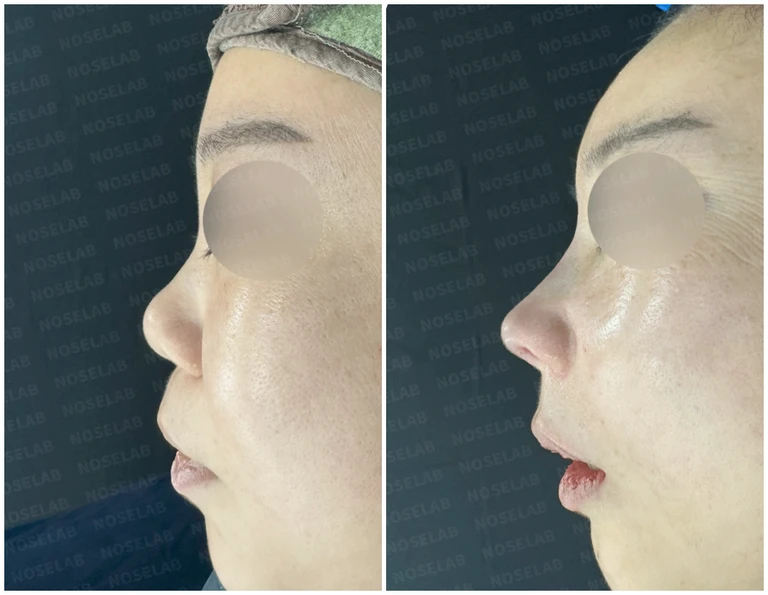 작은 코의 높이와 비율을 고려한 교정 방법 — 전후 비교