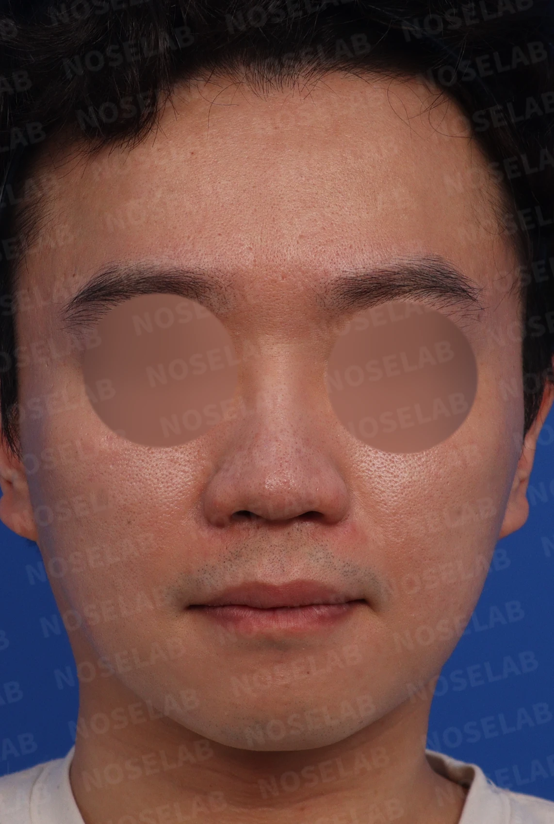 복코와 퍼진 코의 코성형 방법 — 디자인 상담 때 찍은 정면, 측면, 비스듬한 측면 사진입니다.