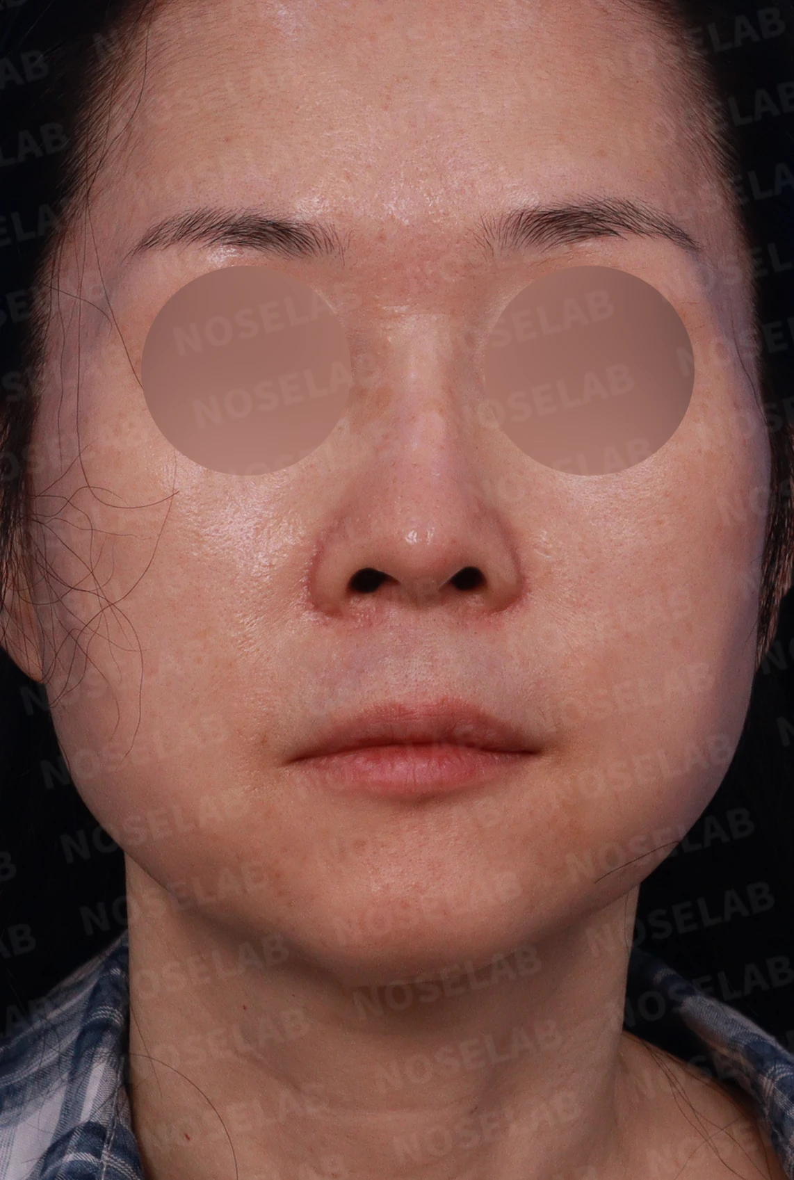오래된 실리콘 피막이 석회화되면 왜 매부리와 휜 코가 생기나 — 디자인 상담 정면 , 좌측 비스듬한 측면 , 측면 사진입니다.