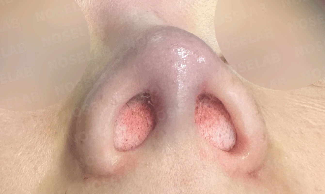 늑연골 석회화를 미리 확인해야 하는 이유와 휜코·짧은코 교정 방법 — 본문 사진 14