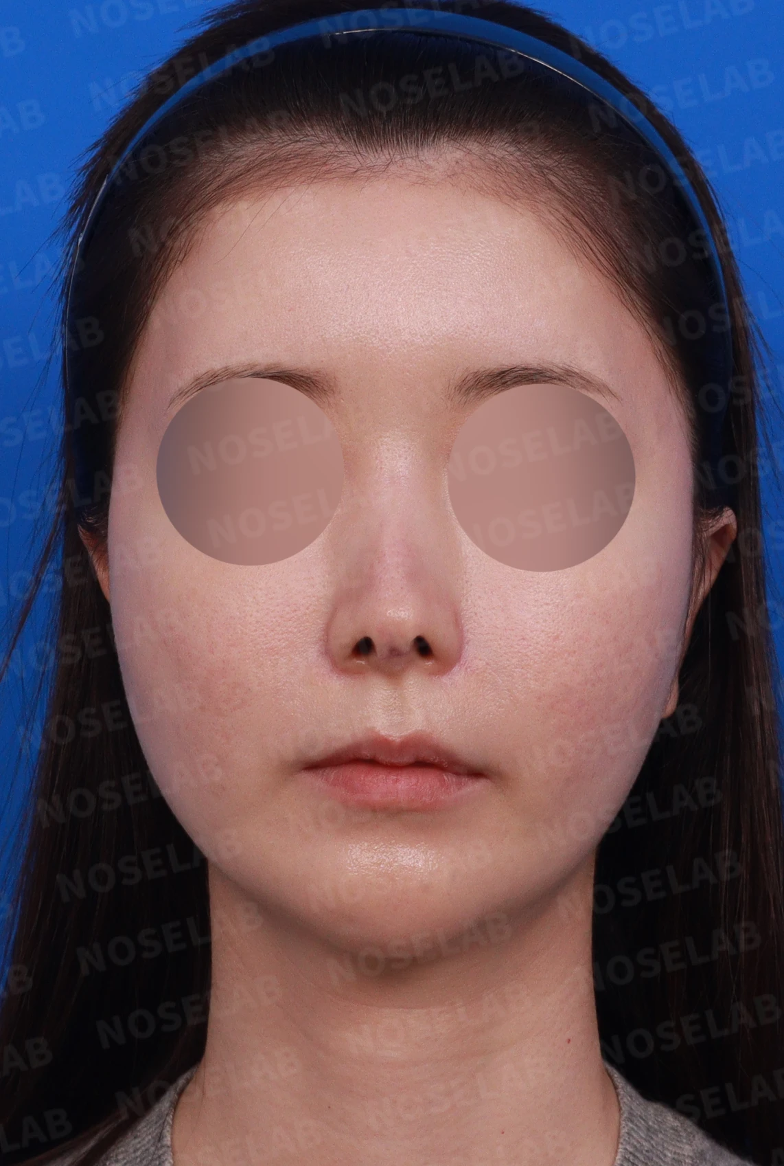 코성형 후 남는 미세한 높이 부족과 좌우 비대칭, 왜 생기고 어떻게 보강하나 — 디자인 상담 정면 , 좌측 측면 , 비스듬한 측면 사진입니다.