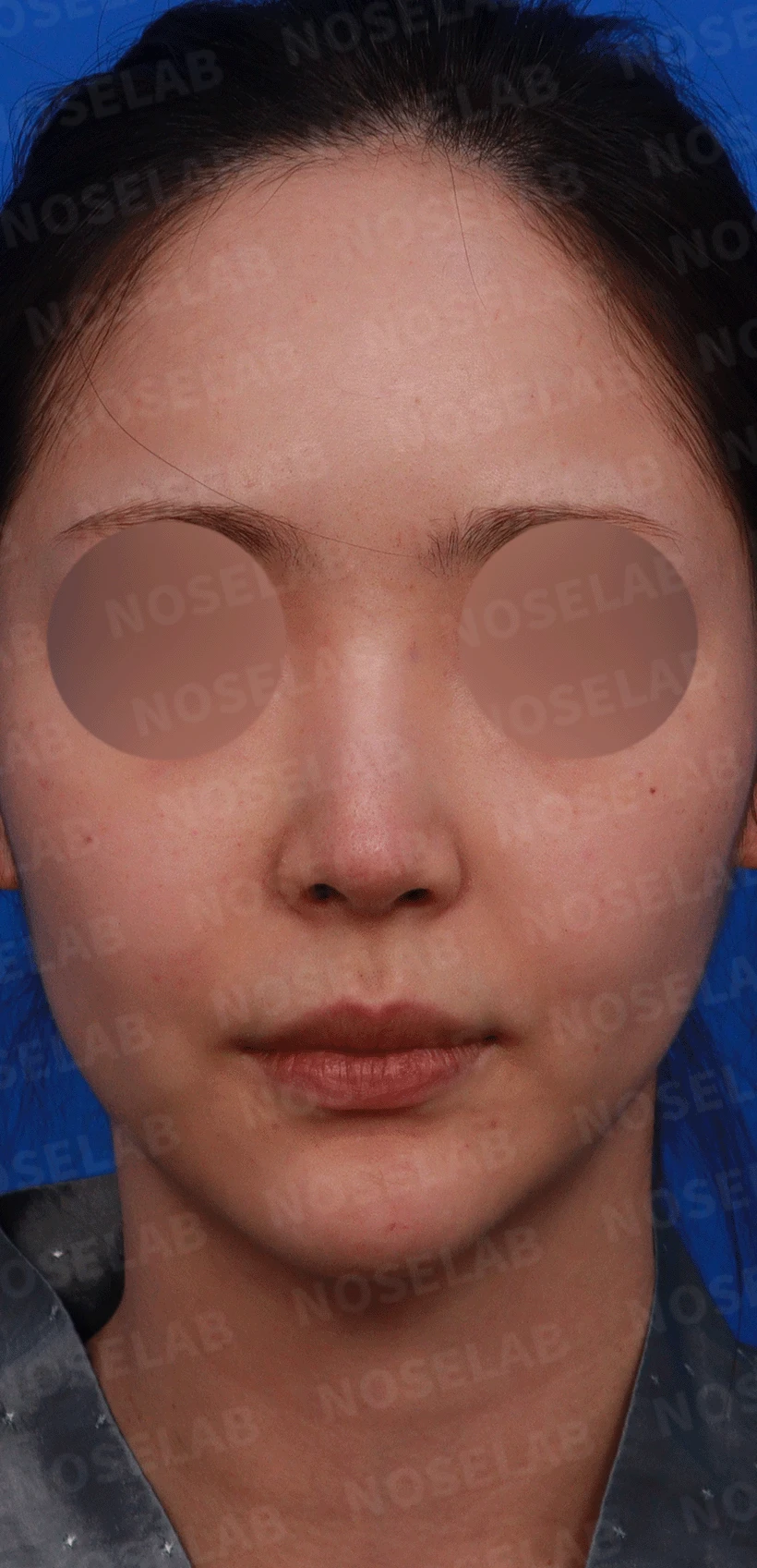코끝 처짐과 코막힘을 함께 살펴보는 재수술 방법 — 디자인 상담 정면, 좌측 측면, 비스듬한 측면 사진입니다.