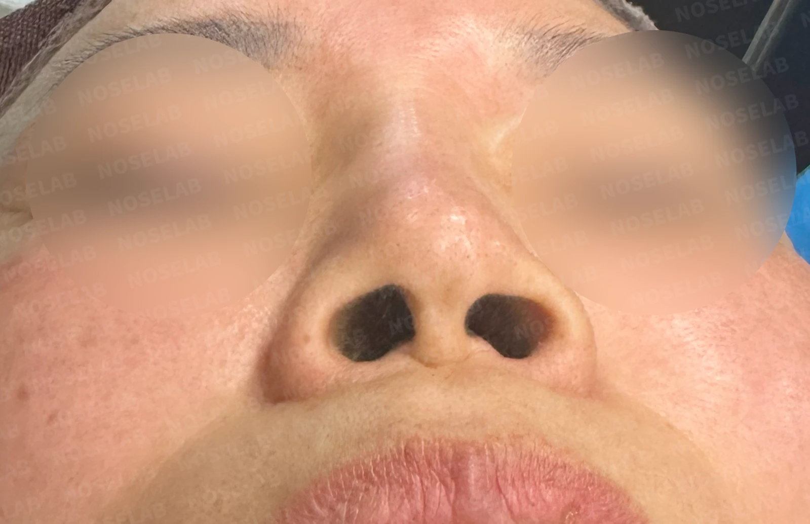 불법 주사 시술 뒤 코가 들리고 짧아지는 이유, 이물질 제거와 재건은 어떻게 하나 — 수술 전 / 수술 직후 0일 직후 사진은 부기가 있는 상태로 최종 결과와 다를 수 있습니다.