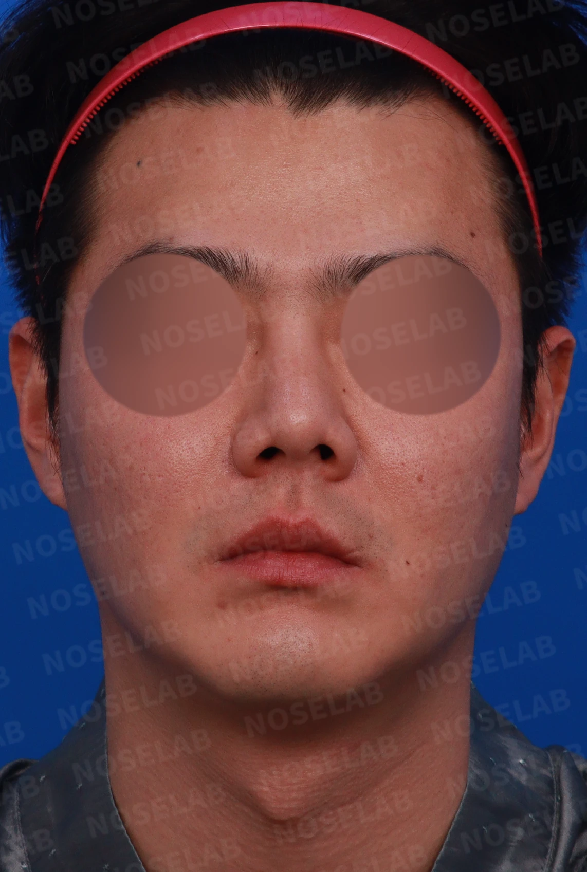 콧구멍 비대칭과 들린 코가 함께 생기는 이유, 늑연골 재건은 어떻게 하나 — 디자인 상담 정면, 좌측 측면, 비스듬한 측면 사진