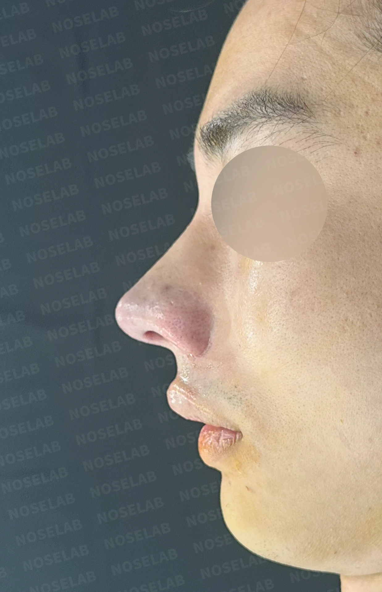 코뼈 골절에 미용 수술을 함께 할 수 있는 경우와 단계로 나누는 방법 — 수술 전 / 수술 직후 0일 직후 사진은 부기가 있는 상태로 최종 결과와 다를 수 있습니다.