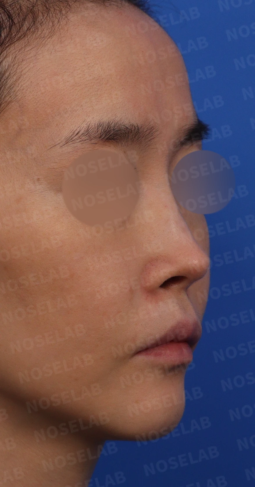 휜코와 콧구멍 비대칭의 재수술 방법 — 수술전 디자인 상담 우측 측면, 비스듬한 측면, 콧구멍 사진입니다.