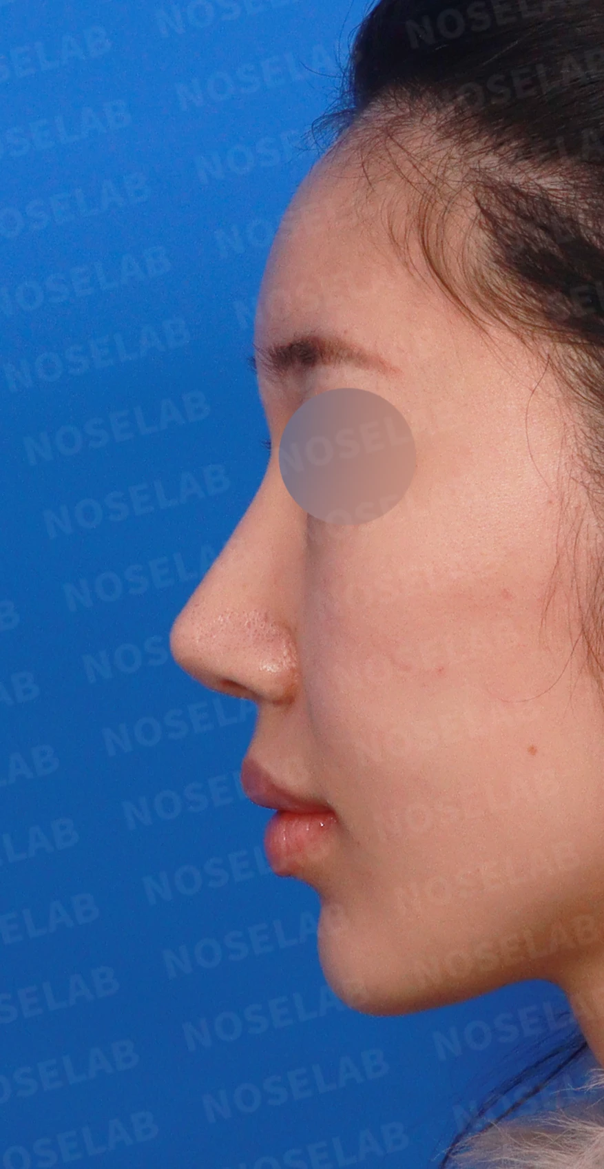 코끝 연골이 피부로 비쳐 보이는 이유와 진피 보강 방법 — 디자인 상담 정면, 좌측 측면, 비스듬한 측면 사진입니다.