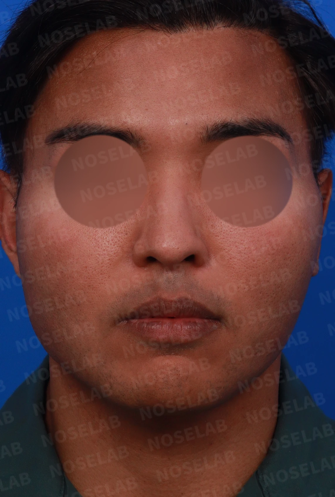 코가 퍼져 보이면서 코막힘이 함께 오는 이유, 절골과 자가 늑연골 교정 방법 — 디자인 상담 정면, 좌측 측면, 비스듬한 측면 사진