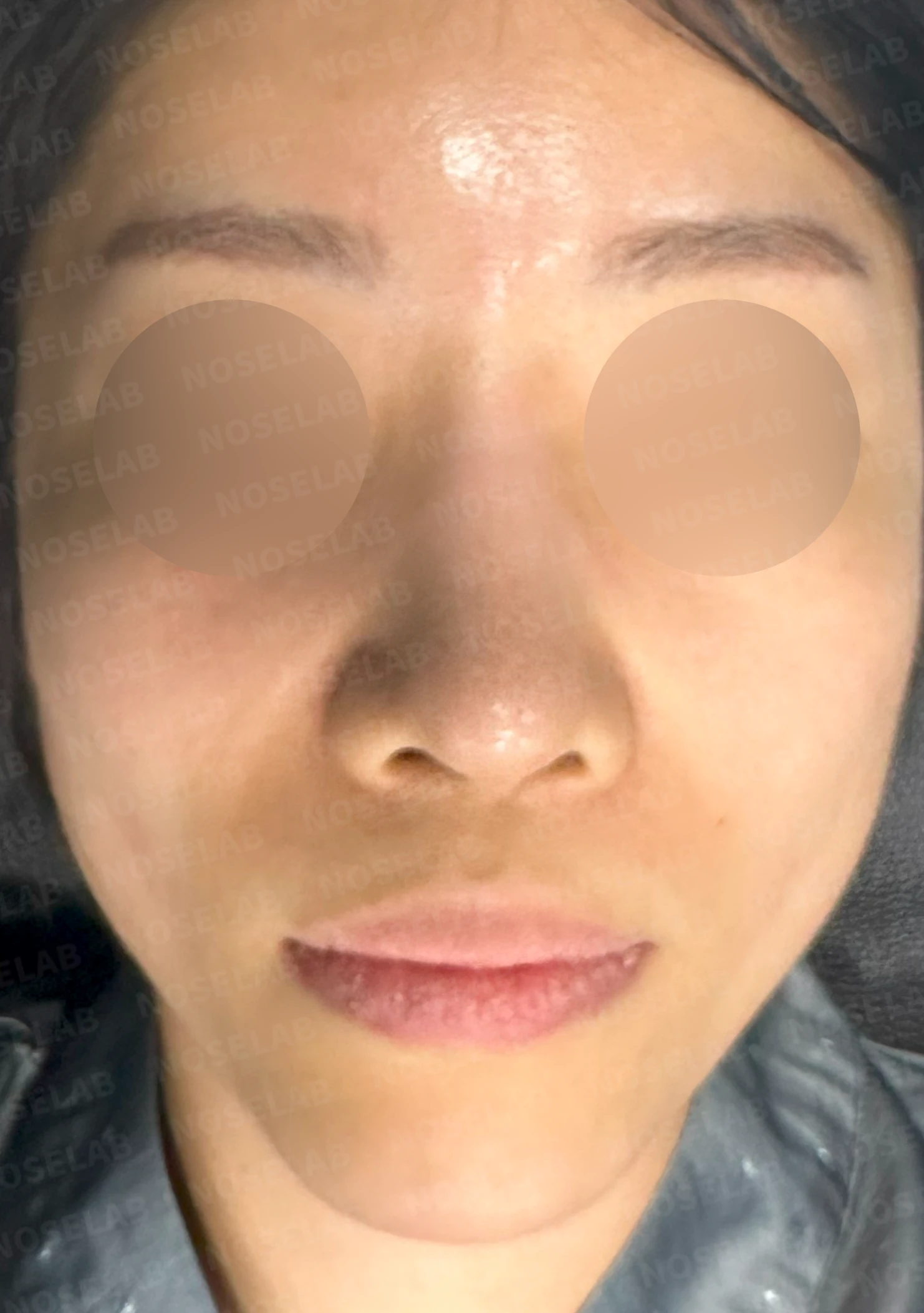 코 수술 뒤 염증이 오래 지속되면 생기는 변화와 재건 방법 — 본문 사진 10