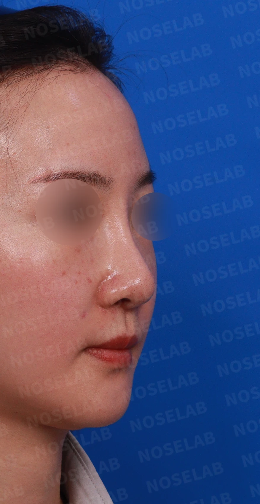 양악수술 뒤 코가 퍼져 보이고 코끝이 처지는 이유, 늑연골 재건 방법 — 디자인 상담 우측 측면 , 비스듬한 측면 , 비공 사진입니다.