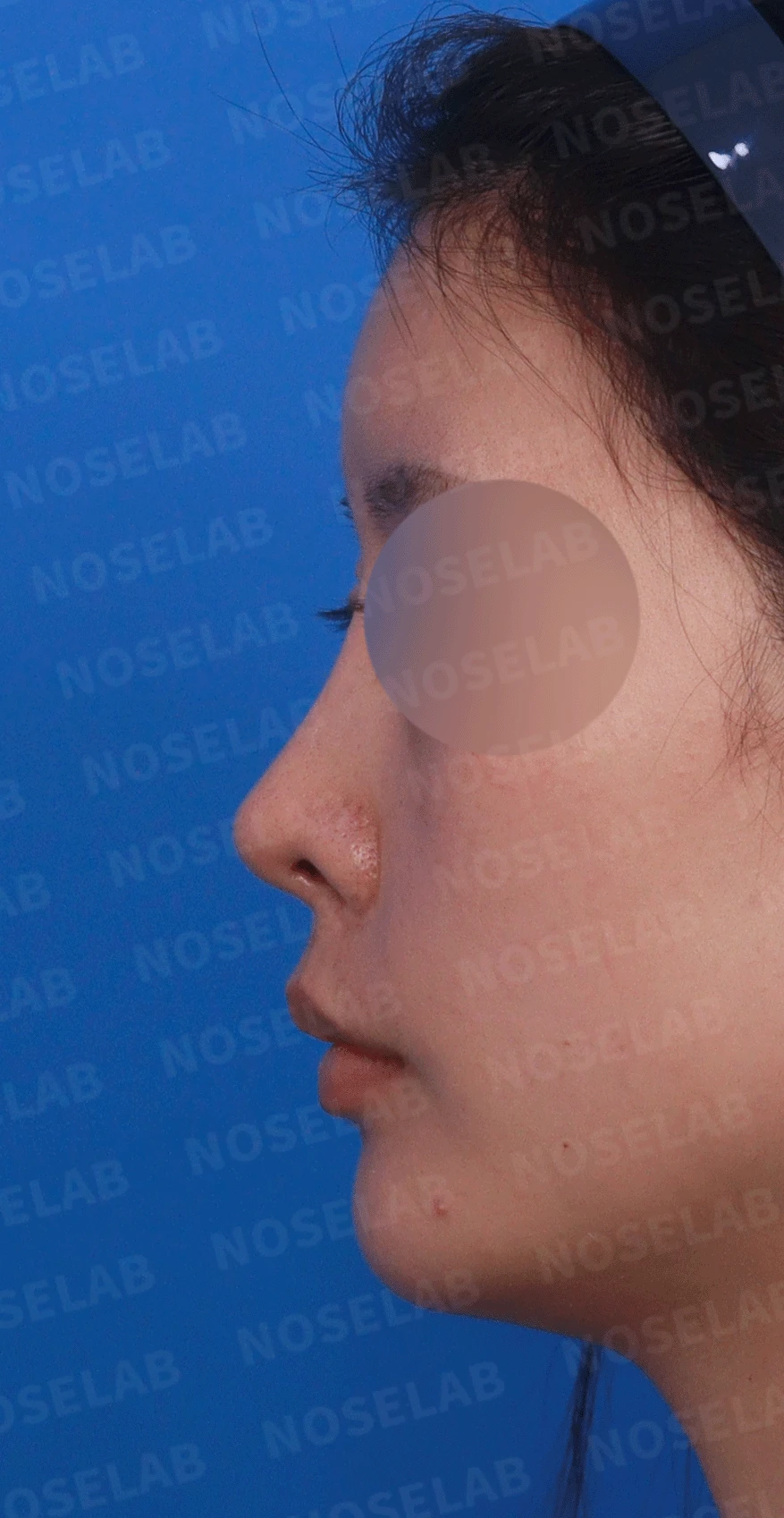 콧대가 인위적으로 보이고 코가 들리는 이유, 재건은 어떻게 하나 — 디자인 상담 정면 , 비스듬한 측면 사진, 좌측 측면