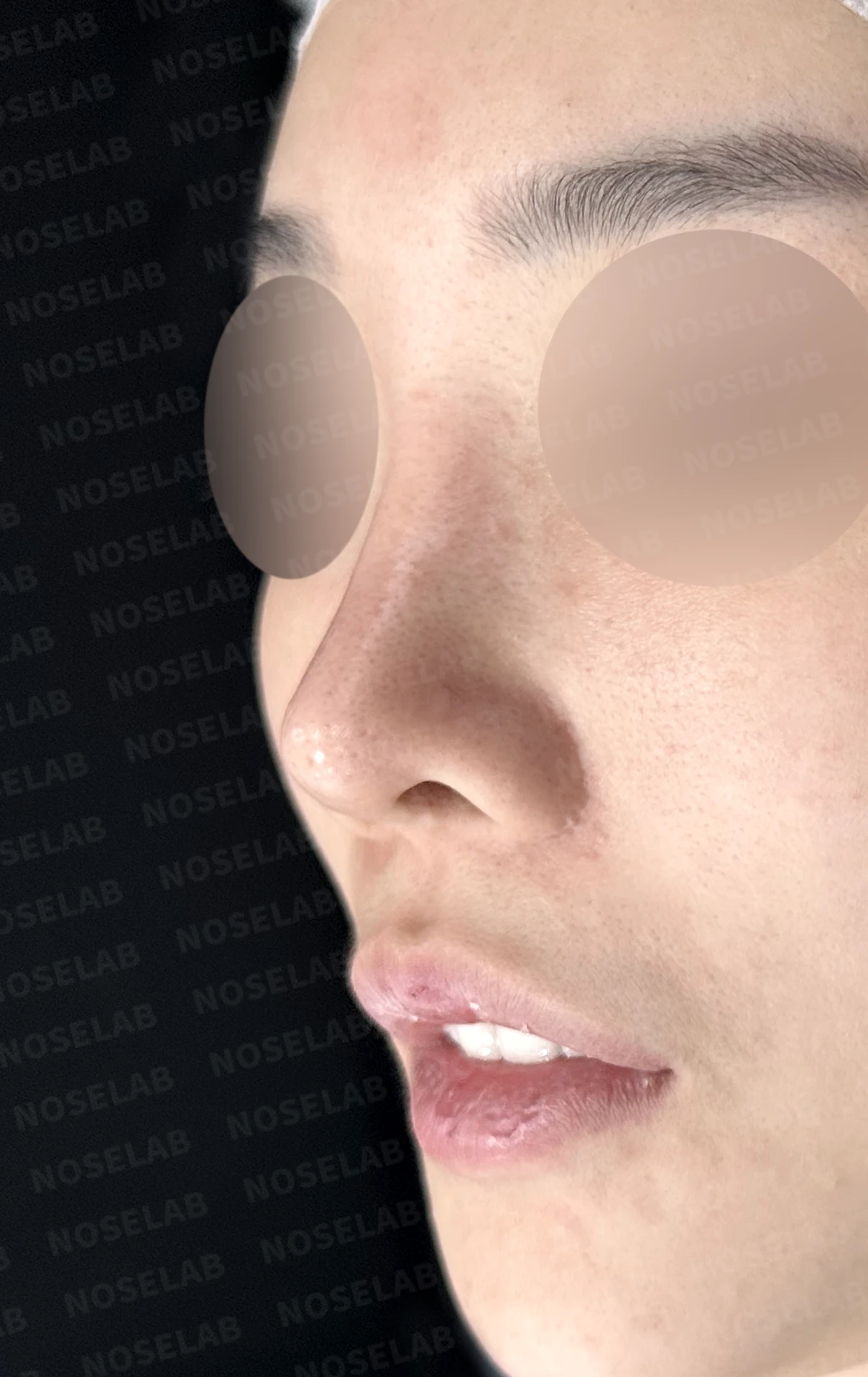 휘어진 코와 퍼진 코끝, 자가늑연골로 세련된 직반라인 완성한 코재수술 — 전(좌) 직후(후)