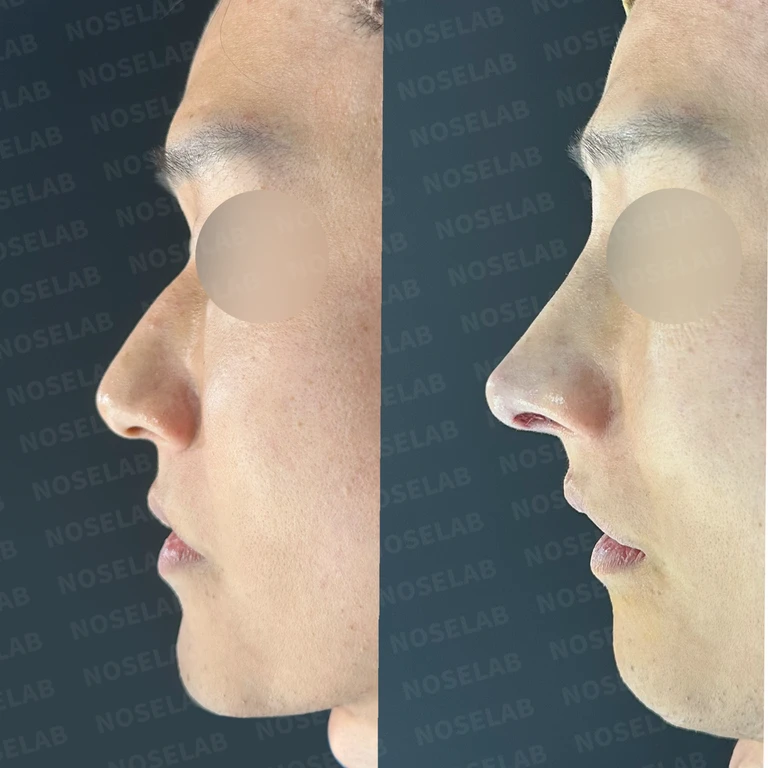 3D프린트 맞춤형 매부리 교정과 퍼진 코끝 개선 사례 — 전후 비교
