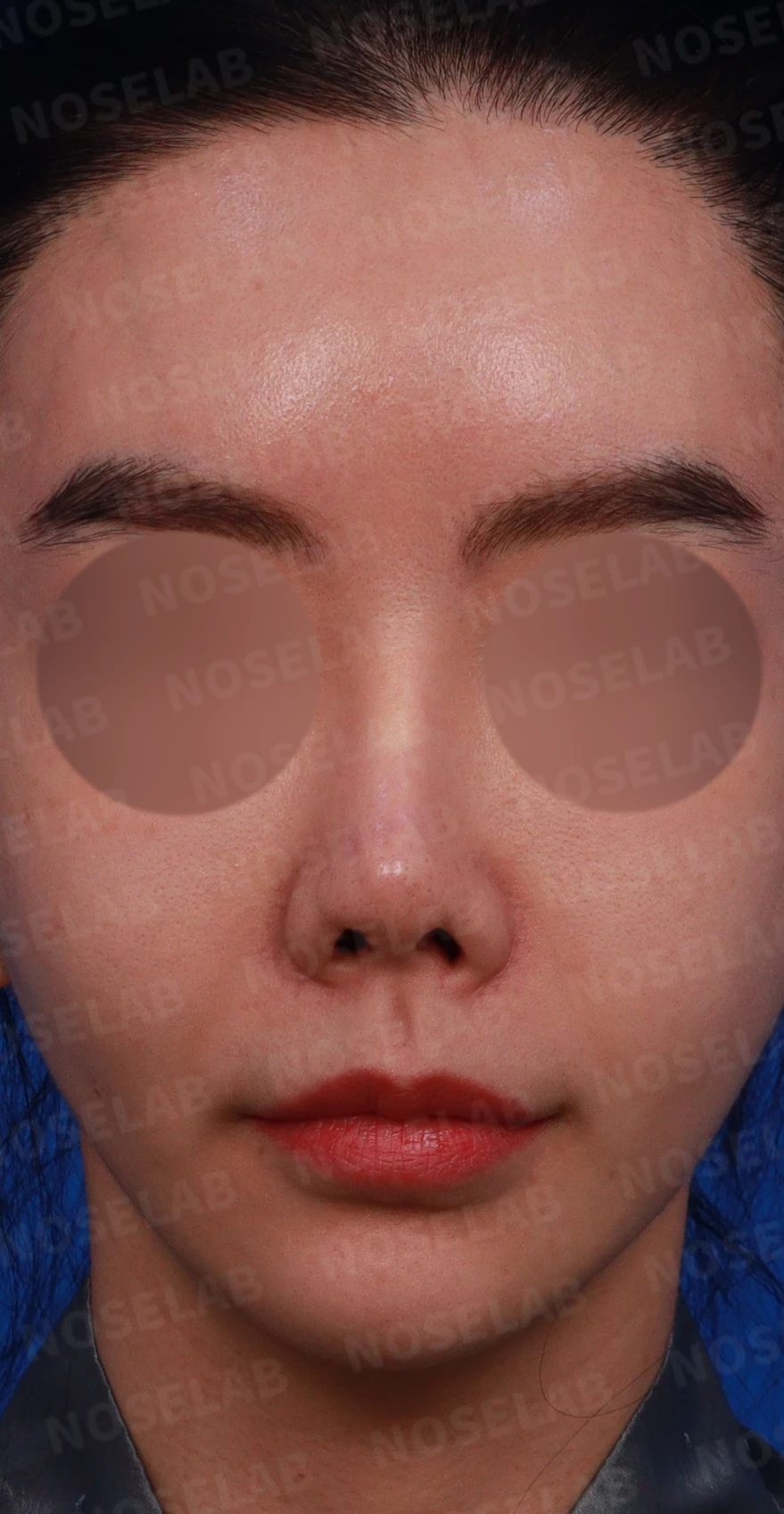 이식한 진피가 반복해서 흡수되는 이유, 재건은 어떻게 하나 — 디자인 상담 정면, 좌측 측면, 비스듬한 측면 사진입니다.
