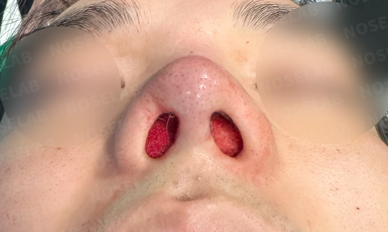 코 실 시술과 지방이식 후 라인이 잡히지 않는 이유, 제거와 늑연골 재건은 어떻게 하나 — 수술 전 / 수술 직후 0일 직후 사진은 부기가 있는 상태로 최종 결과와 다를 수 있습니다.