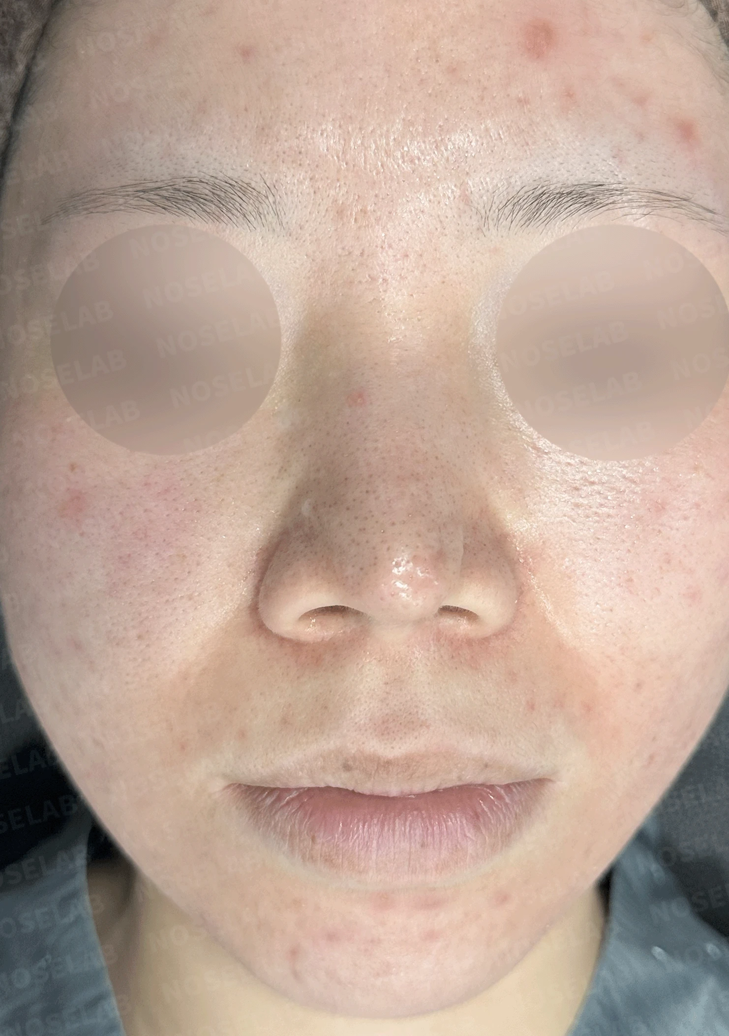 콧구멍을 막는 종괴가 생기는 이유, 제거와 재건은 어떻게 하나 — 본문 사진 15
