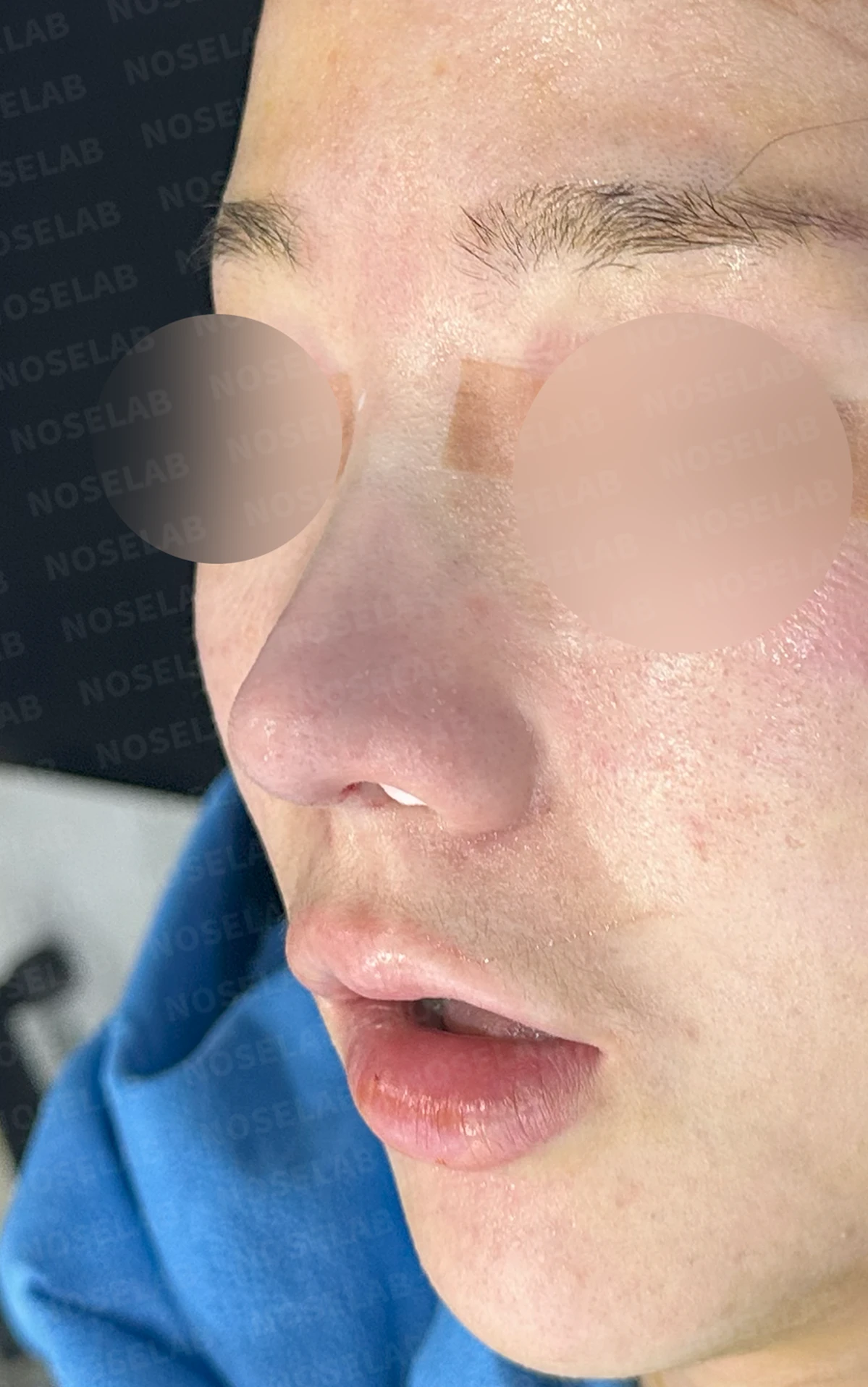 비중격 연골이 손상되면 코끝이 처지고 비주가 함몰되는 이유 — 수술 직후 0일 정면 , 측면 , 비스듬한 측면 사진 직후 사진은 부기가 있는 상태로 최종 결과와 다를 수 있습니다.