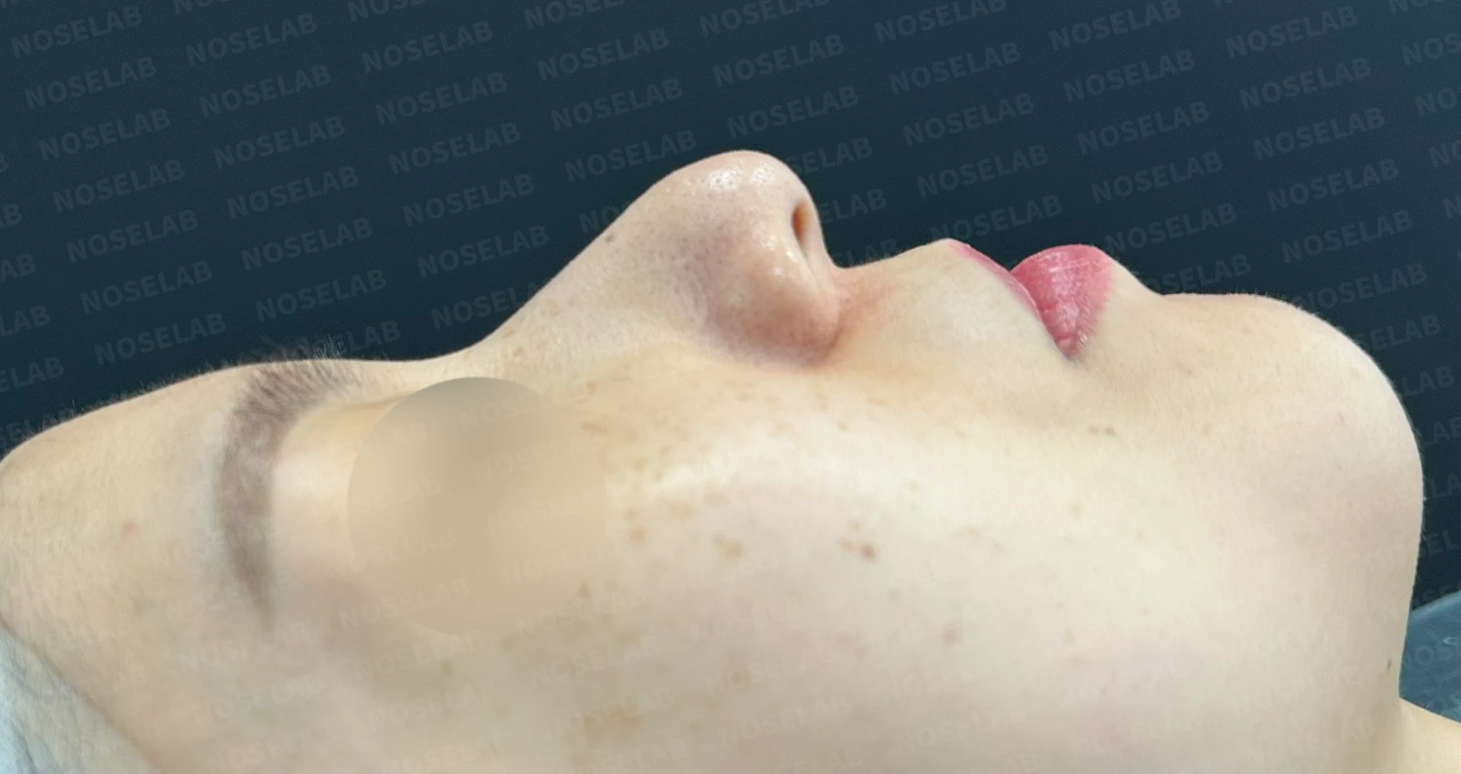 복코, 퍼진코 교정 방법 — 수술 전 / 수술 직후 0일 직후 사진은 부기가 있는 상태로 최종 결과와 다를 수 있습니다.