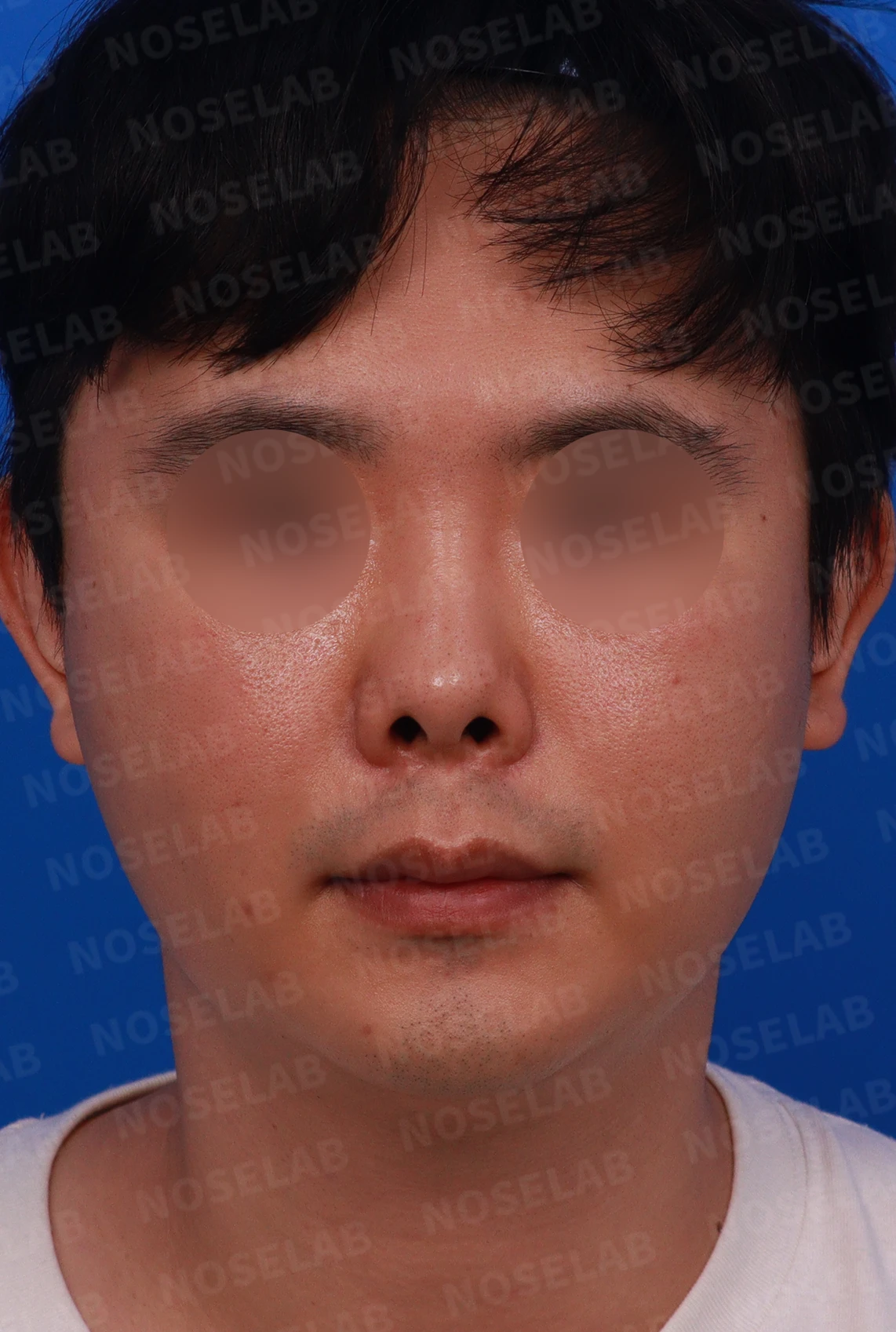 비중격 연골을 많이 쓴 코가 들리고 막히는 이유, 재건은 어떻게 하나 — 디자인 상담 정면 , 좌측 비스듬한 측면 , 측면 사진입니다.